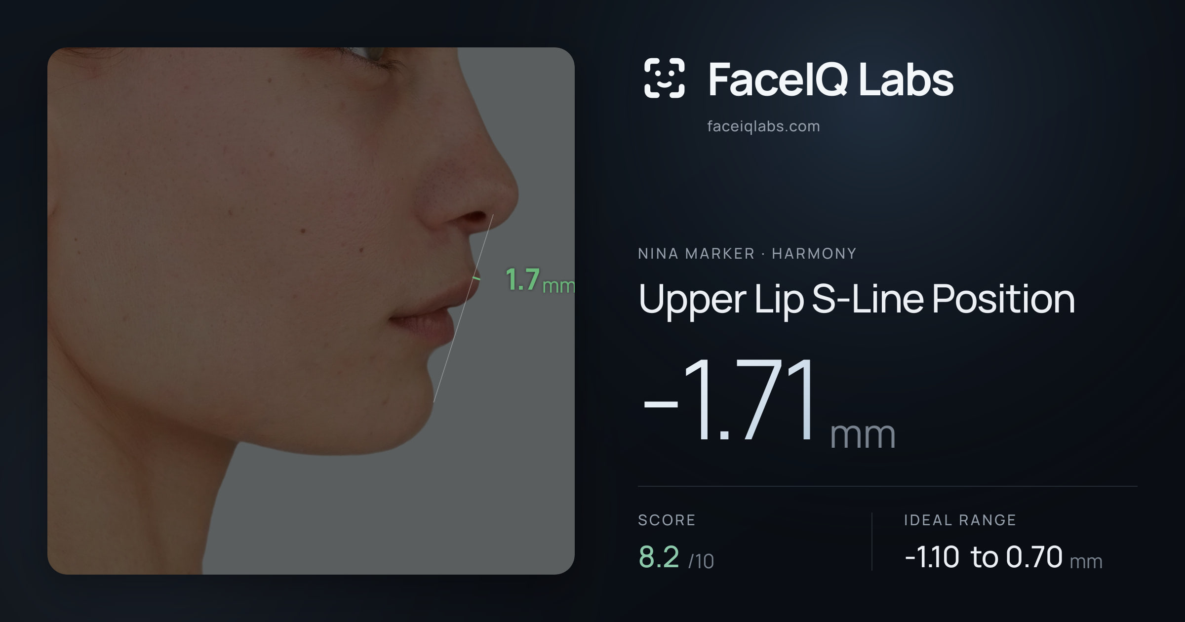 Nina Marker Upper Lip S-Line Position: -1.71mm, drawn on the photo