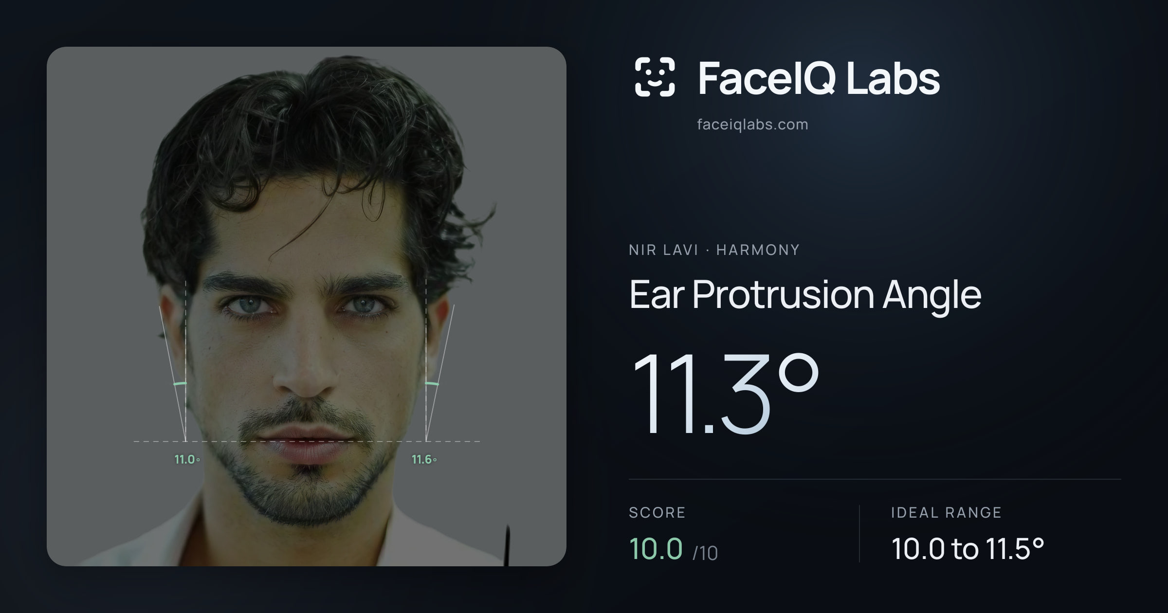 Nir Lavi Ear Protrusion Angle: 11.3°, drawn on the photo