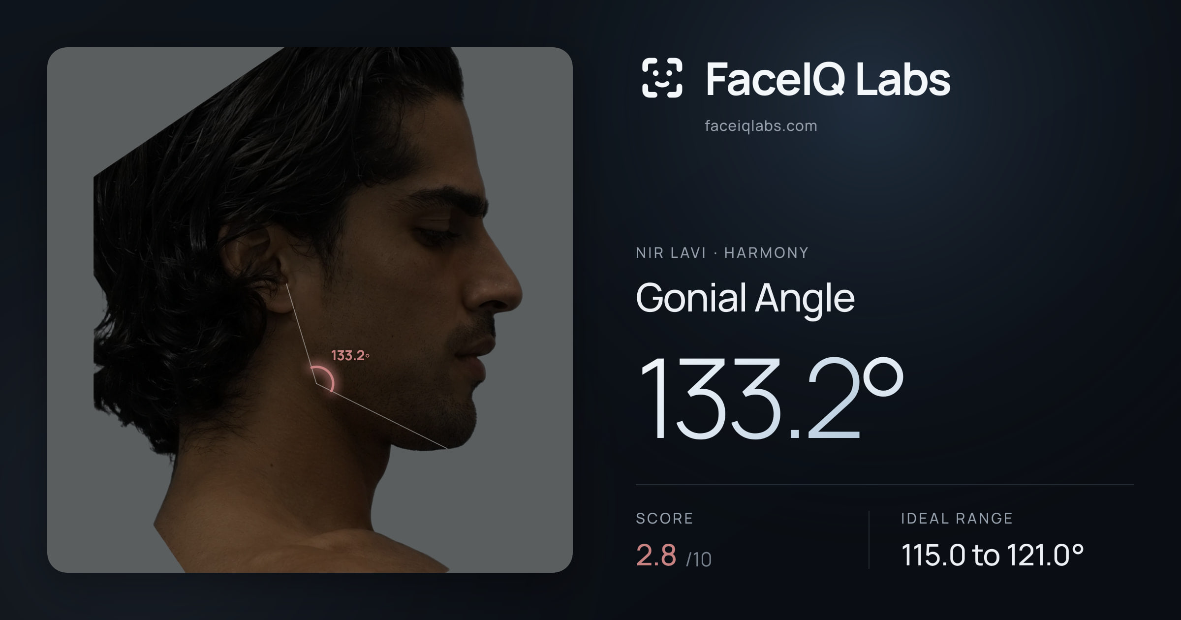 Nir Lavi Gonial Angle: 133.2°, drawn on the photo