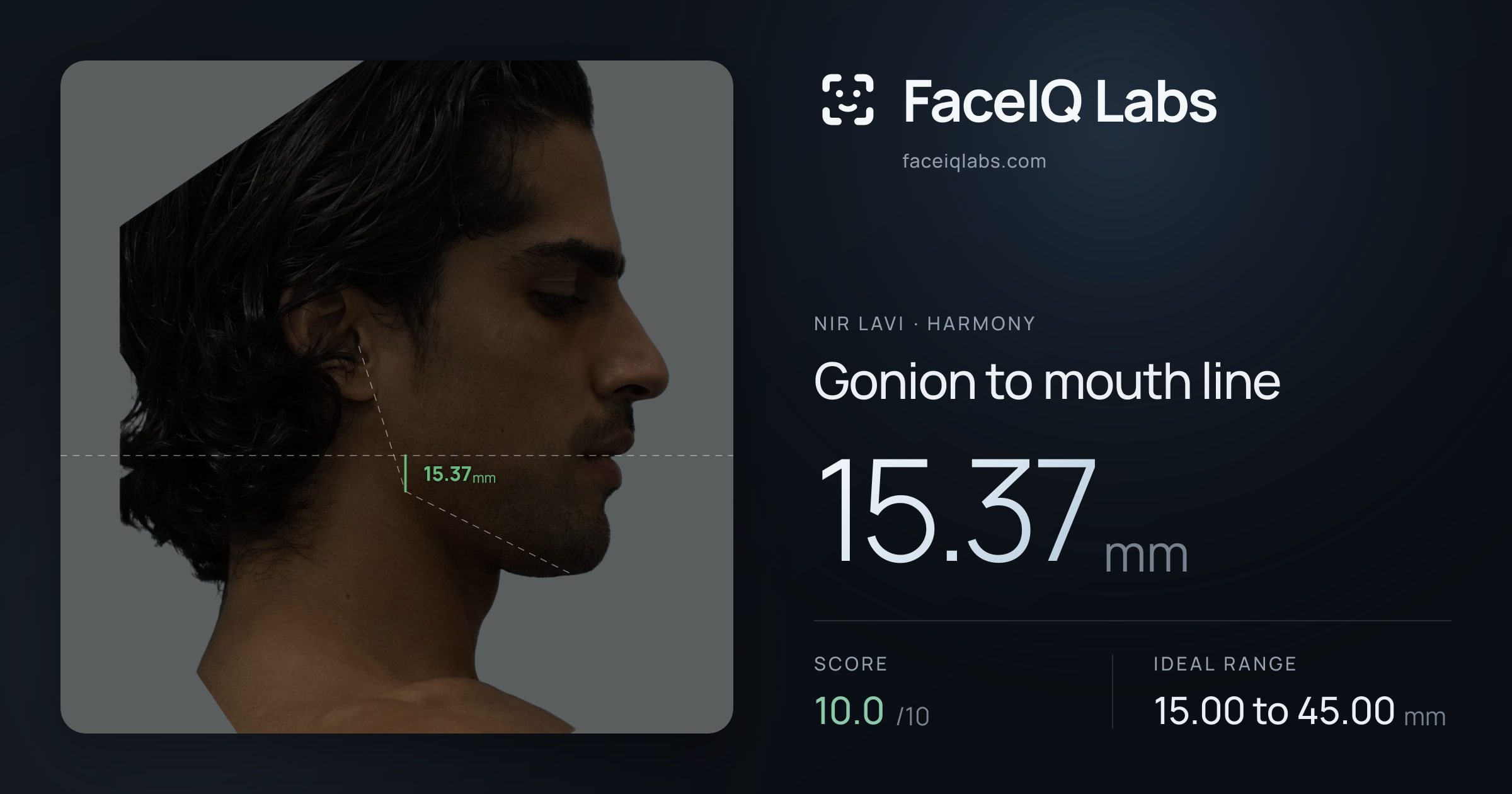 Nir Lavi Gonion to mouth line: 15.37mm, drawn on the photo