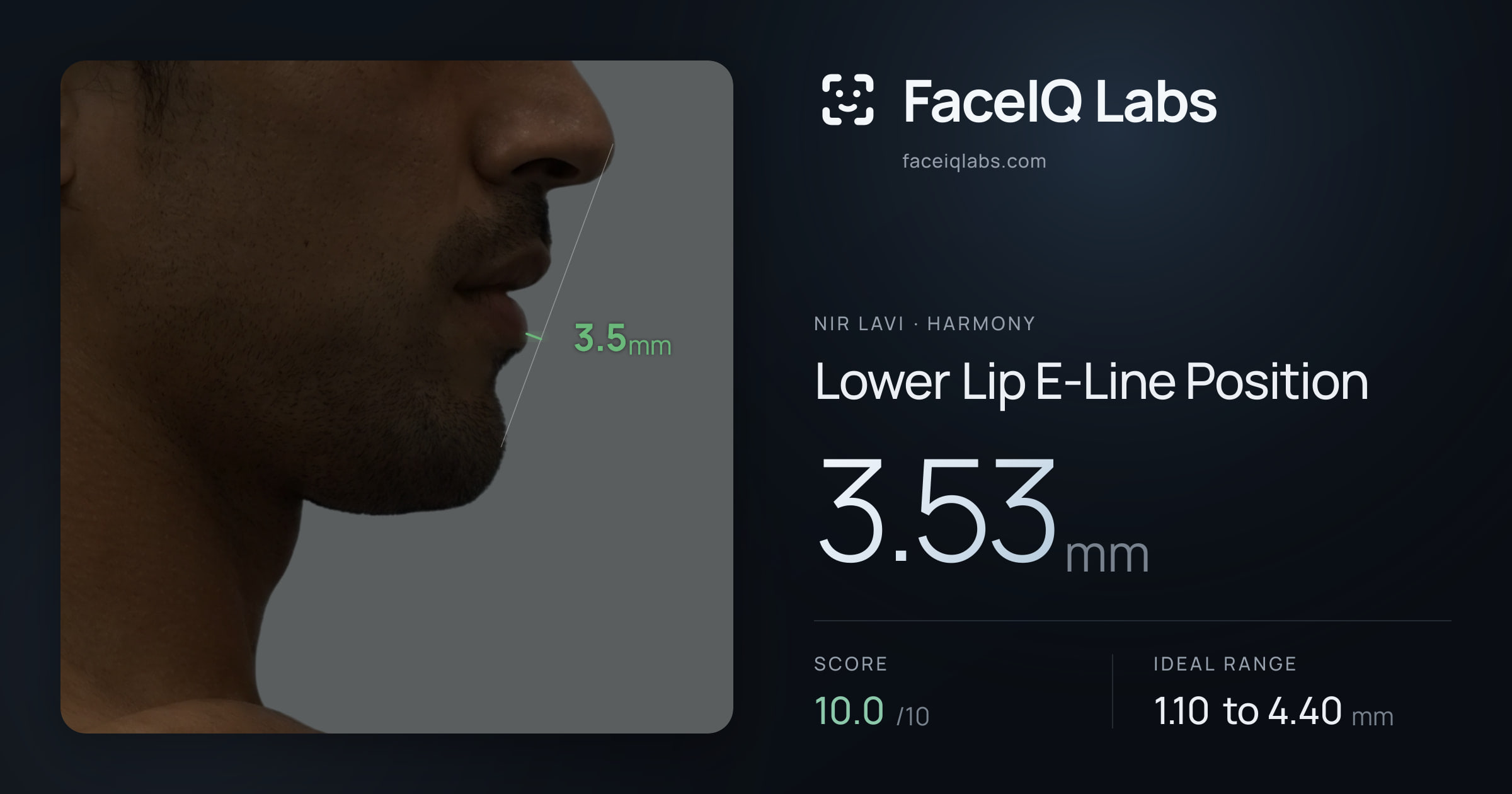 Nir Lavi Lower Lip E-Line Position: 3.53mm, drawn on the photo