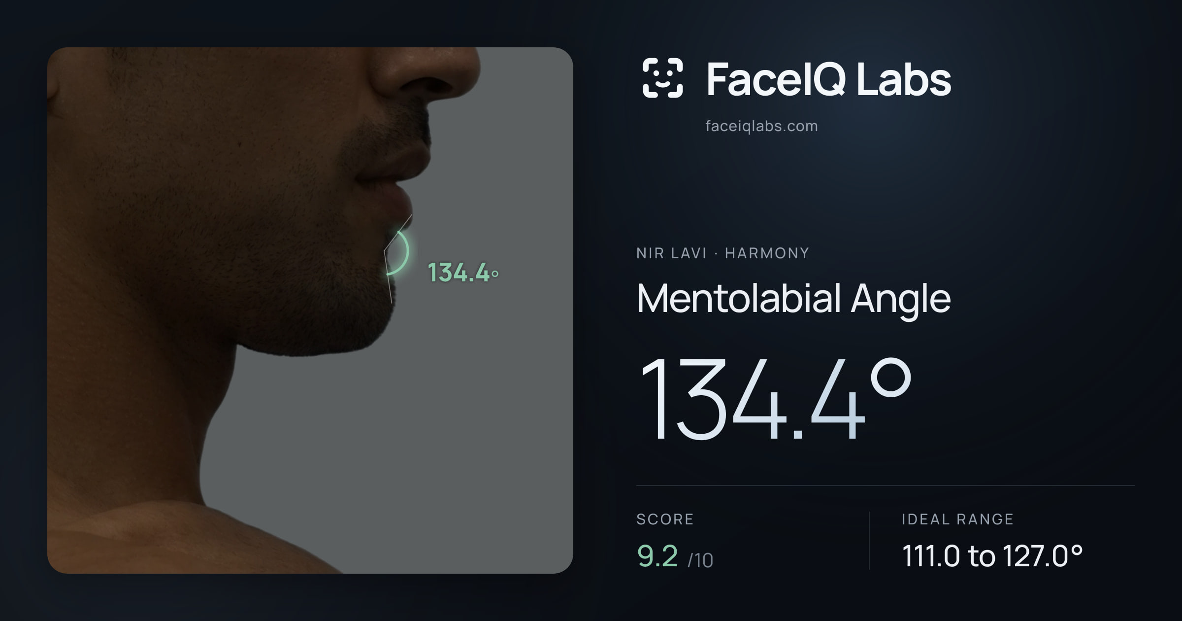 Nir Lavi Mentolabial Angle: 134.4°, drawn on the photo