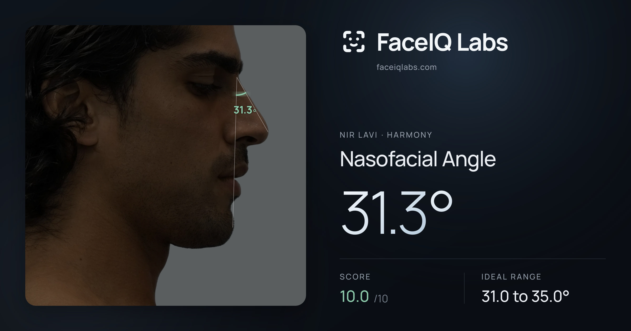 Nir Lavi Nasofacial Angle: 31.3°, drawn on the photo