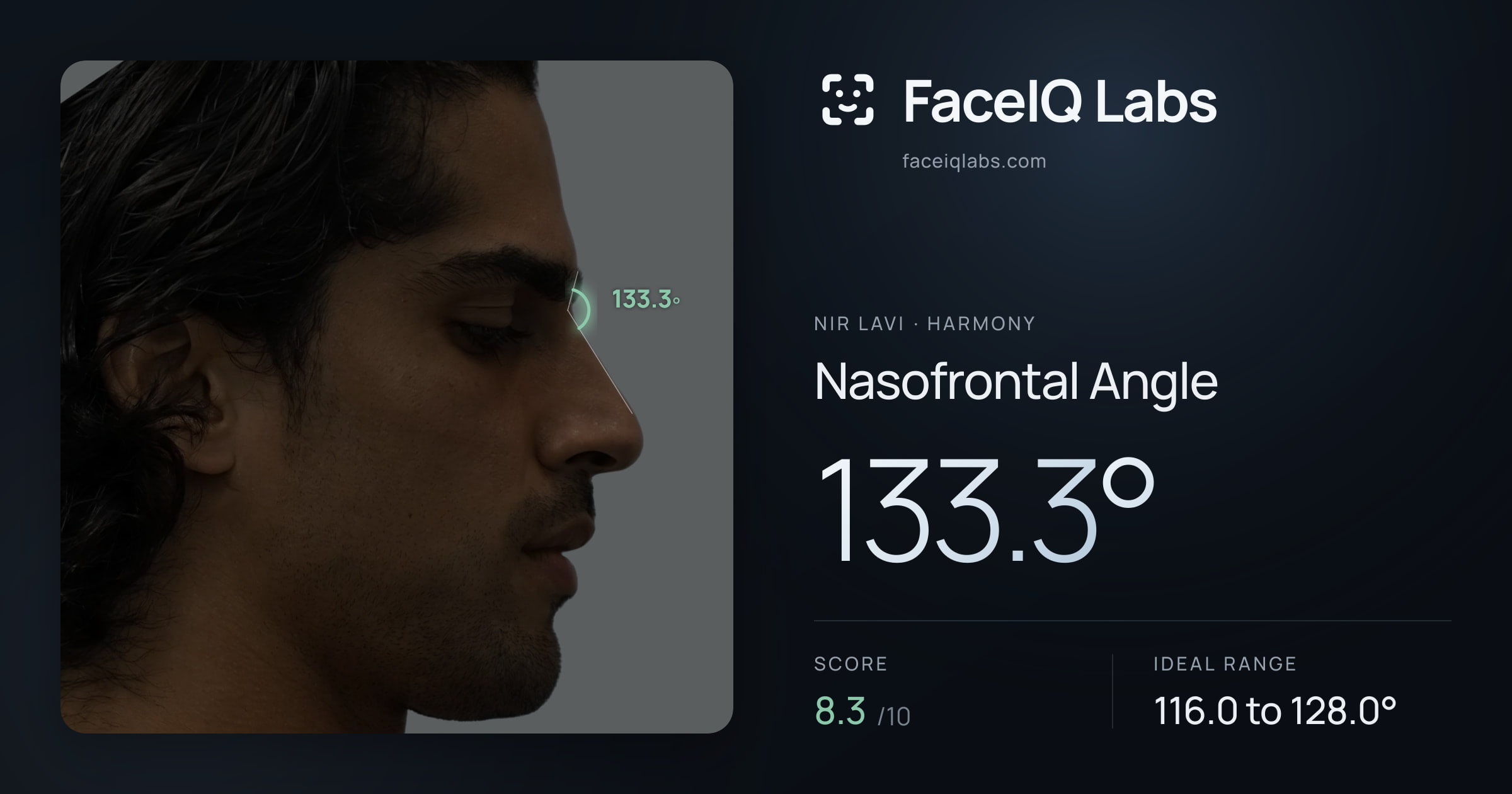 Nir Lavi Nasofrontal Angle: 133.3°, drawn on the photo
