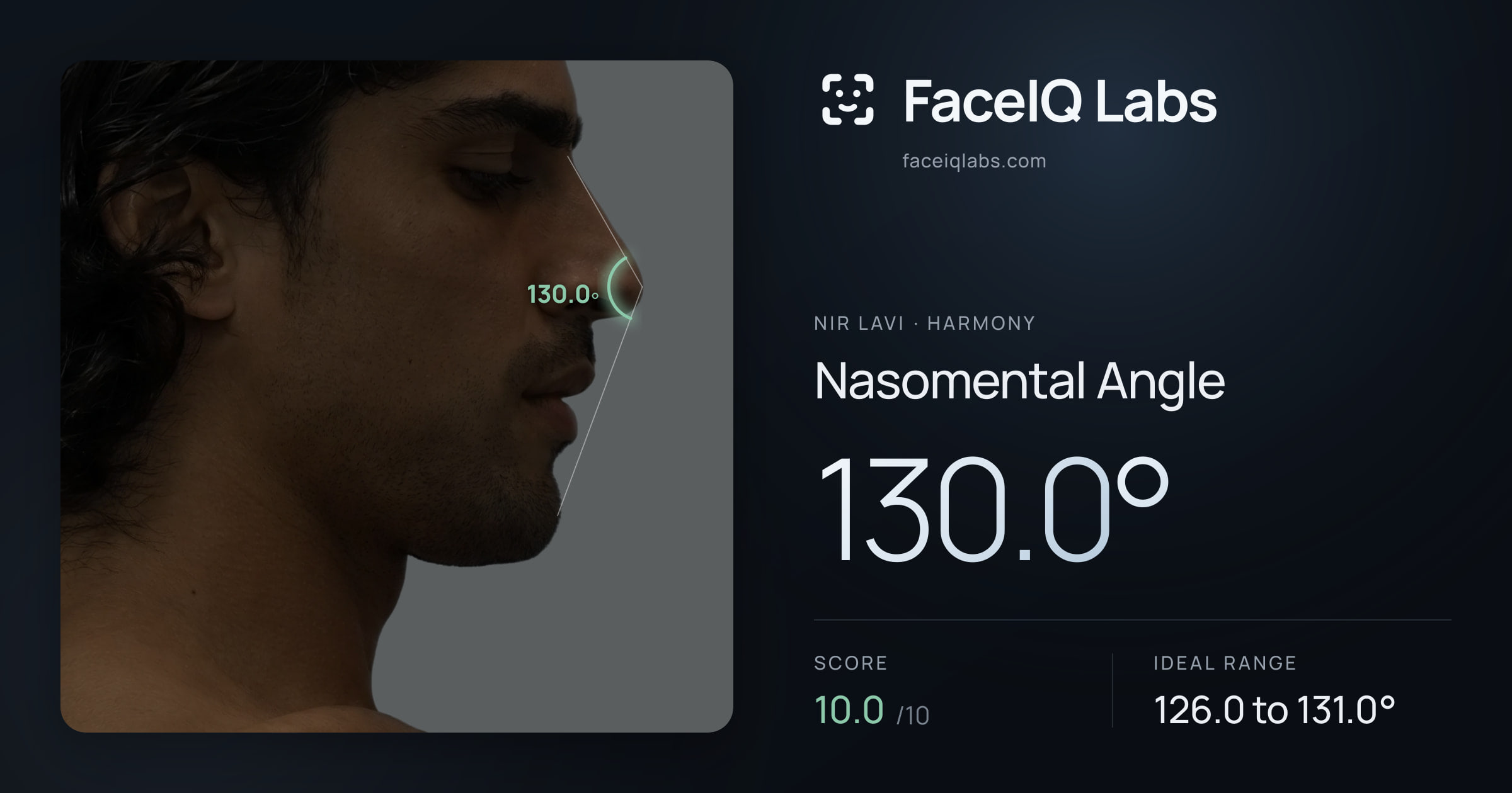 Nir Lavi Nasomental Angle: 130.0°, drawn on the photo