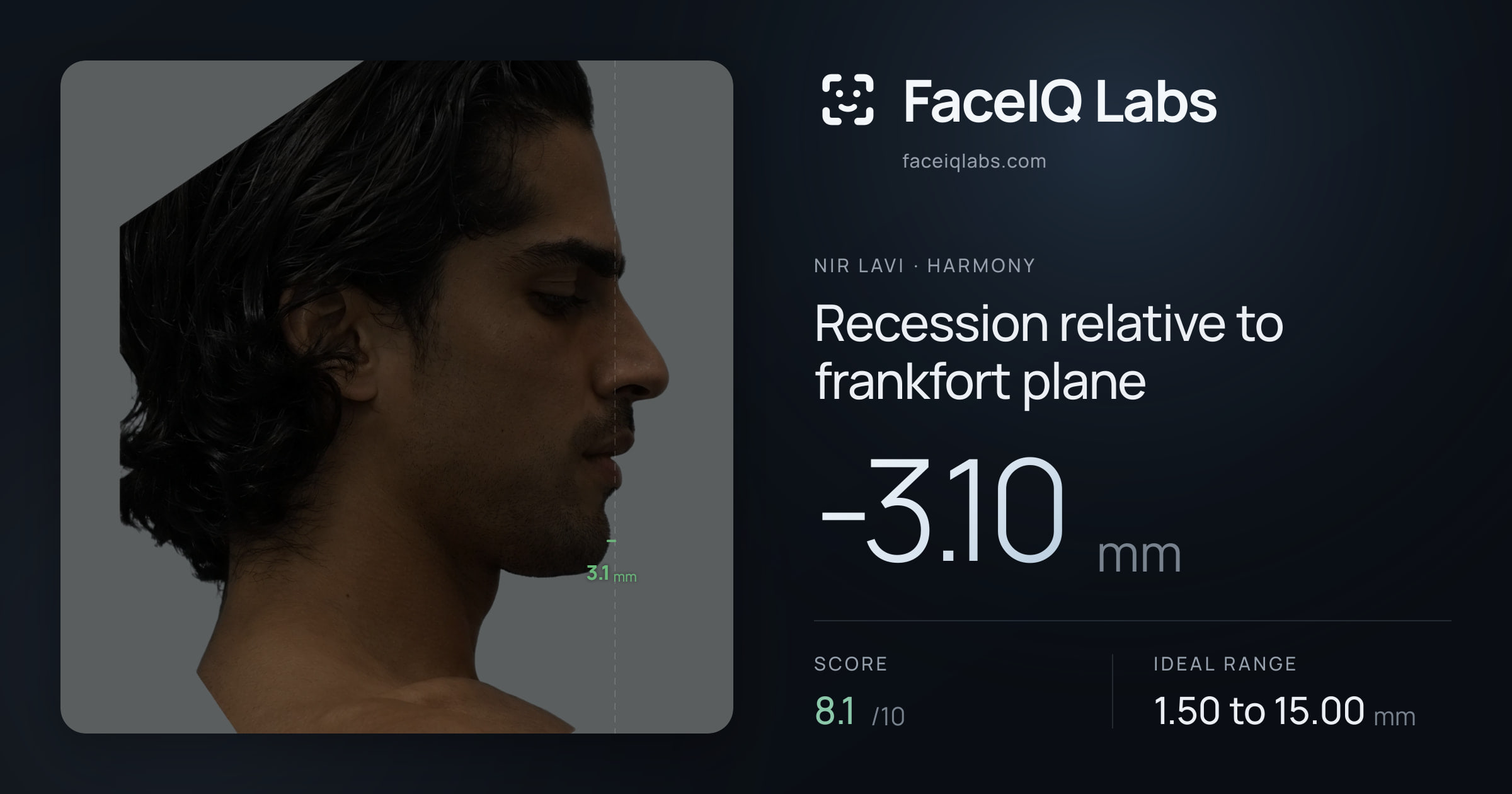 Nir Lavi Recession relative to frankfort plane: -3.10mm, drawn on the photo