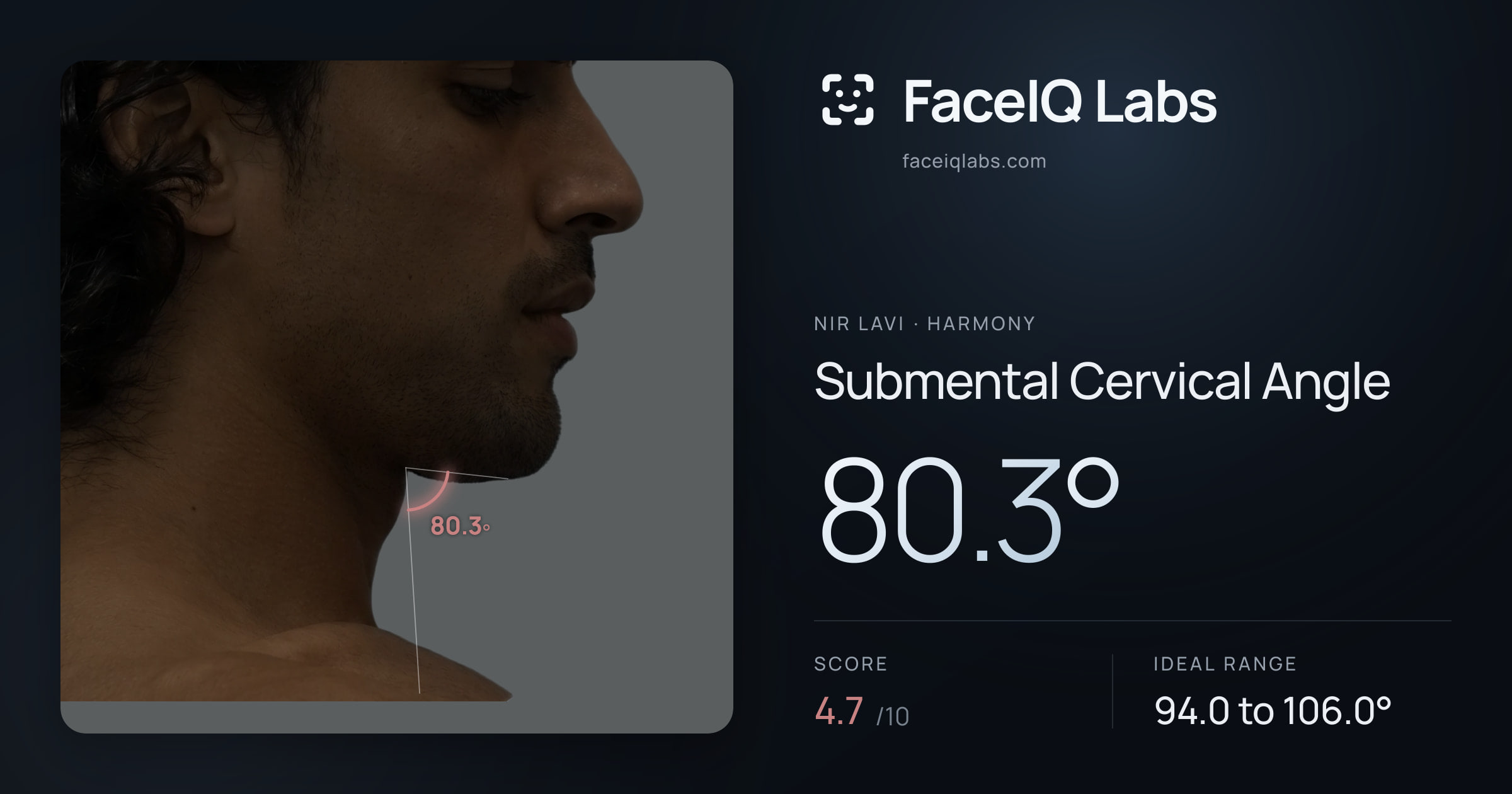 Nir Lavi Submental Cervical Angle: 80.3°, drawn on the photo