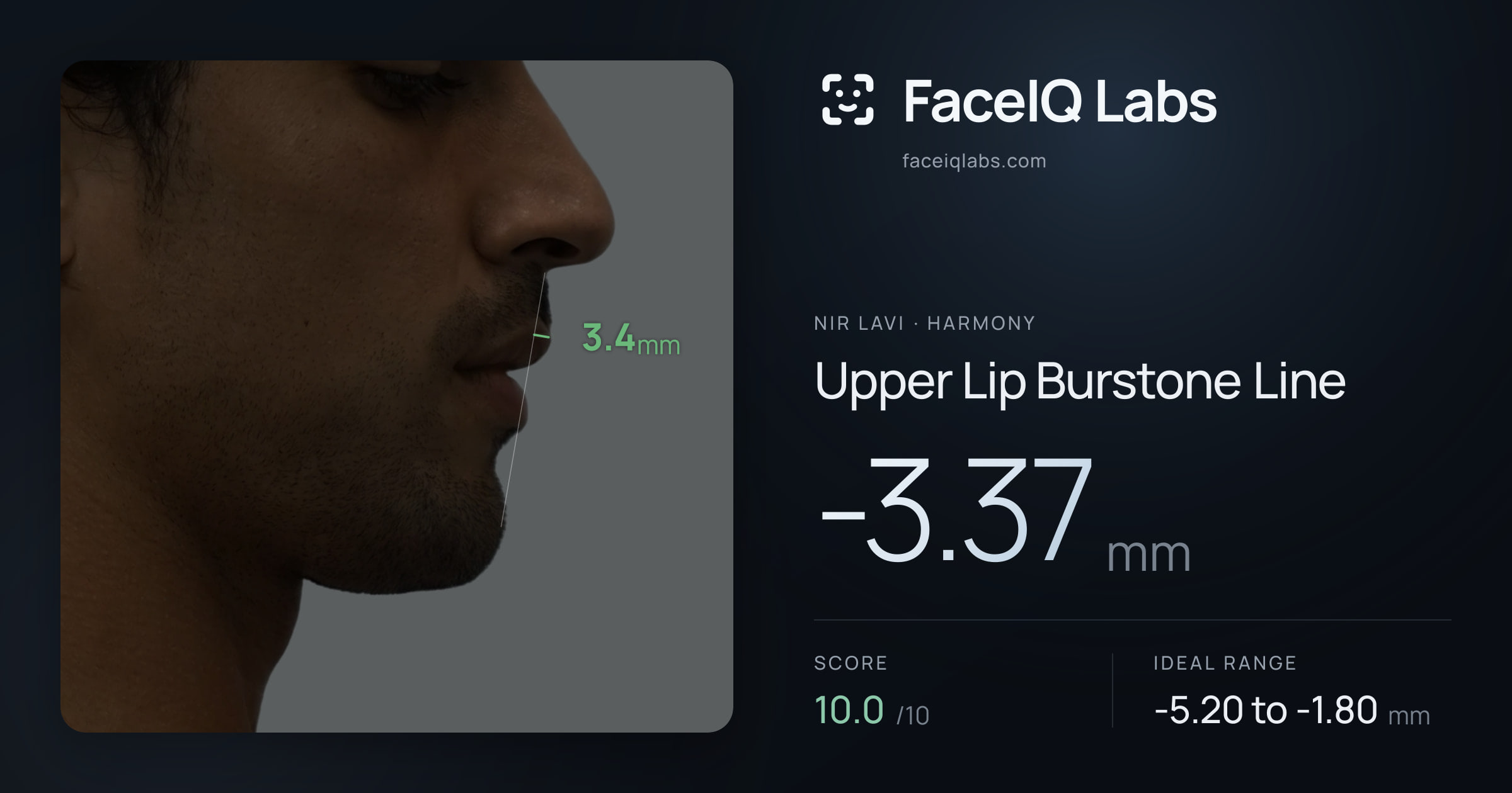 Nir Lavi Upper Lip Burstone Line: -3.37mm, drawn on the photo