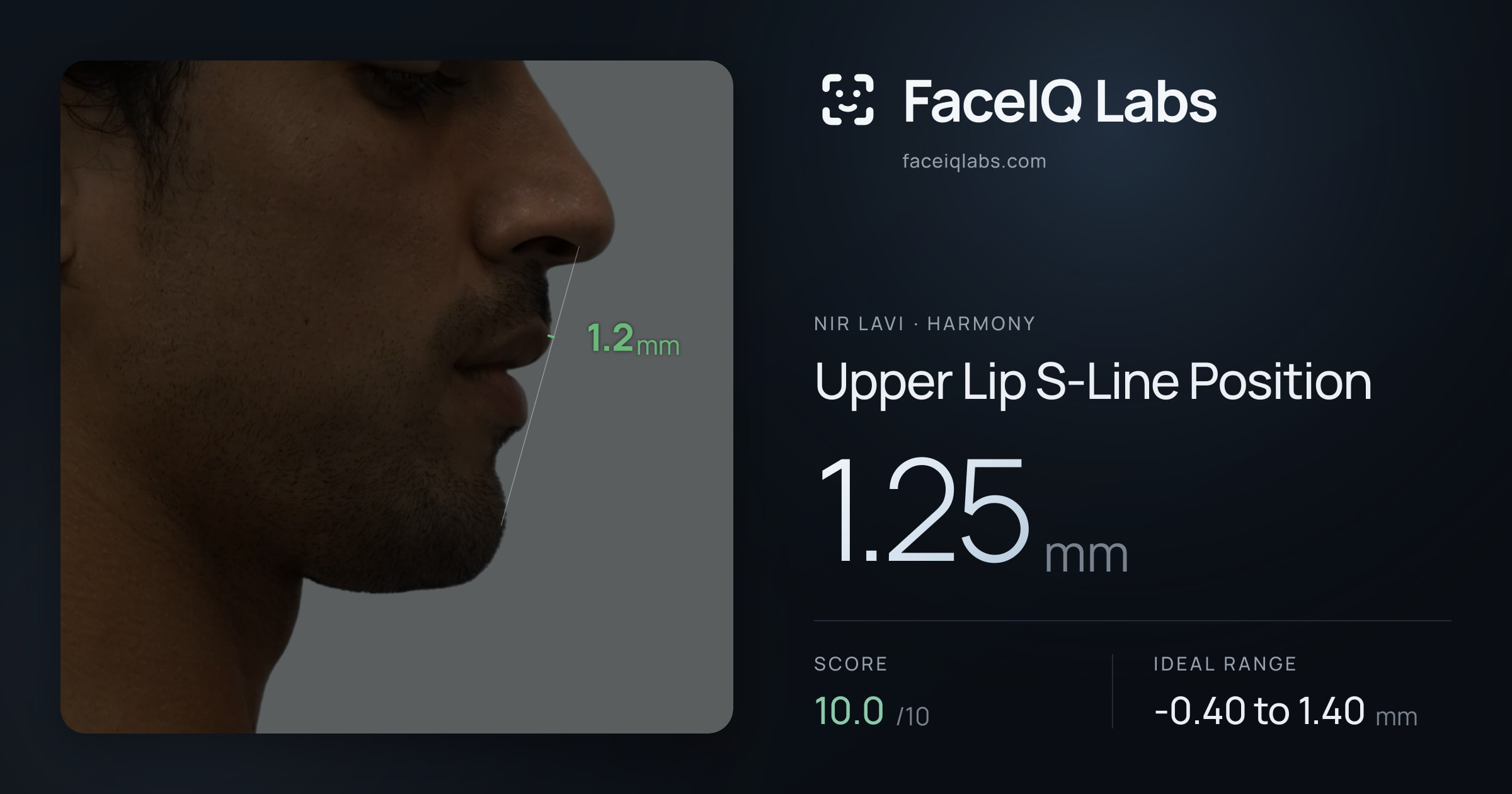 Nir Lavi Upper Lip S-Line Position: 1.25mm, drawn on the photo