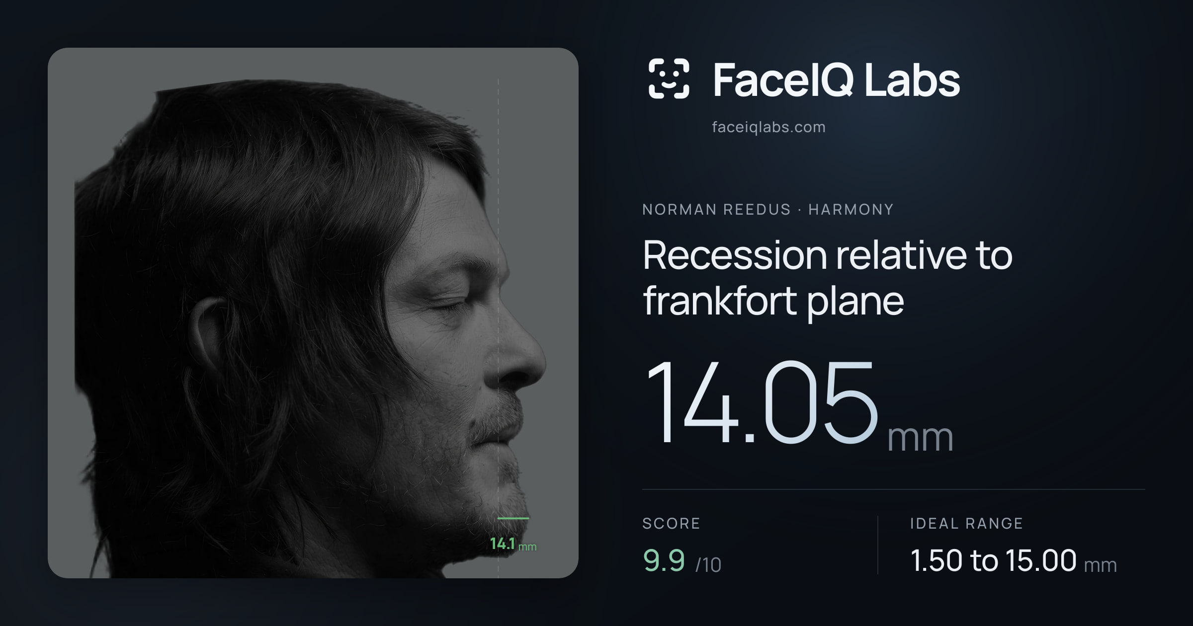 Norman Reedus Recession relative to frankfort plane: 14.05mm, drawn on the photo
