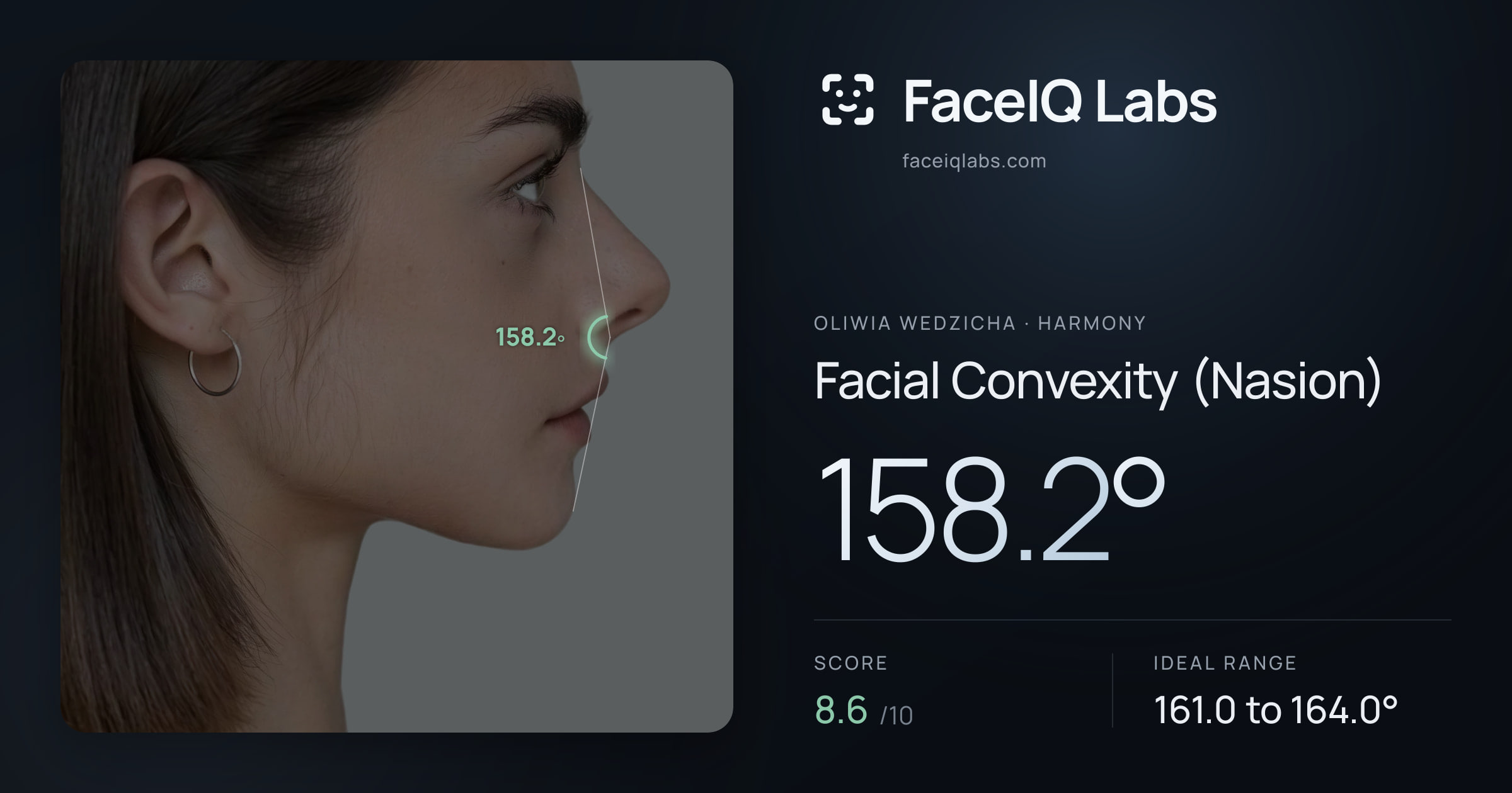 Oliwia Wedzicha Facial Convexity (Nasion): 158.2°, drawn on the photo