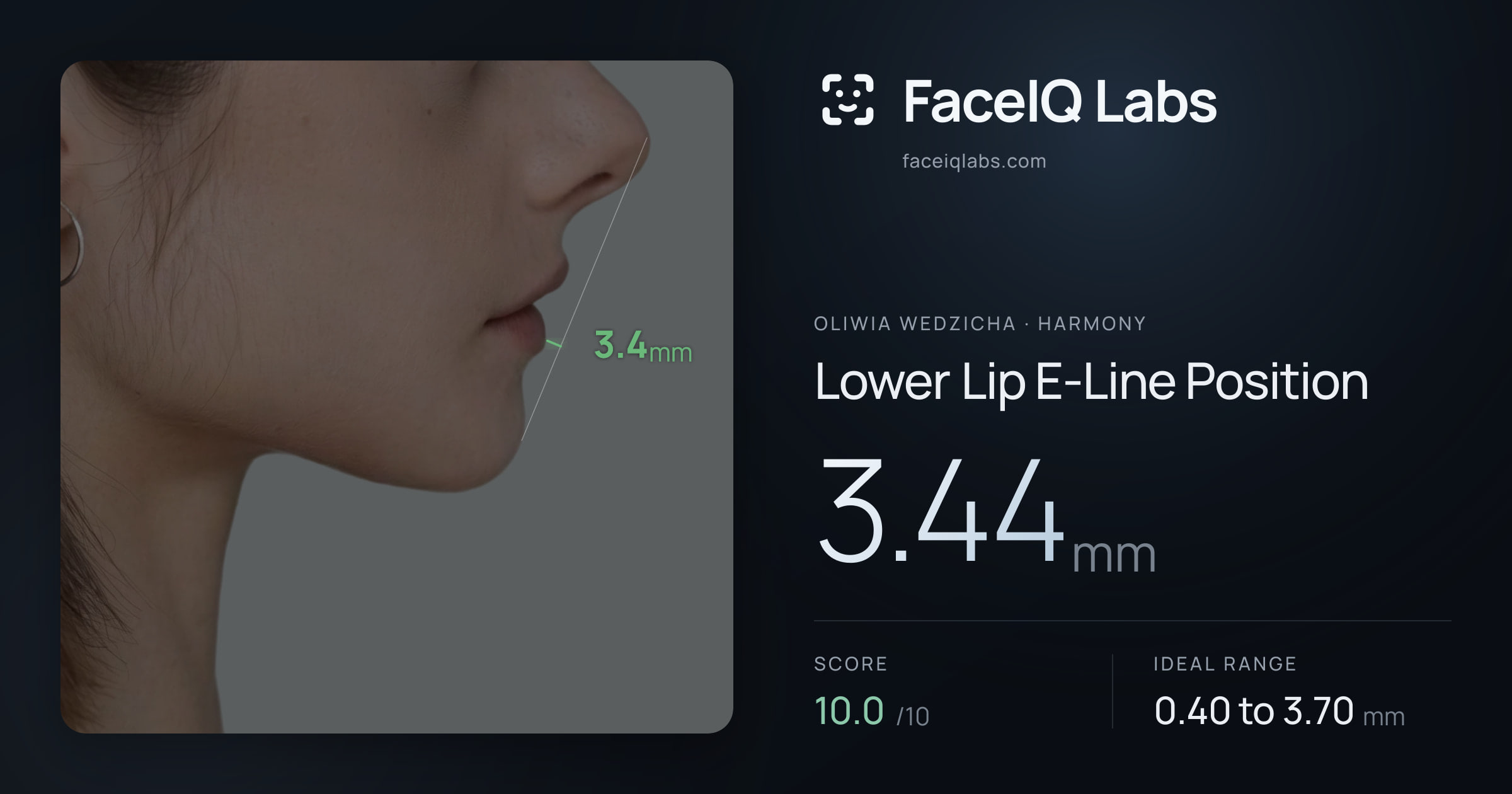 Oliwia Wedzicha Lower Lip E-Line Position: 3.44mm, drawn on the photo