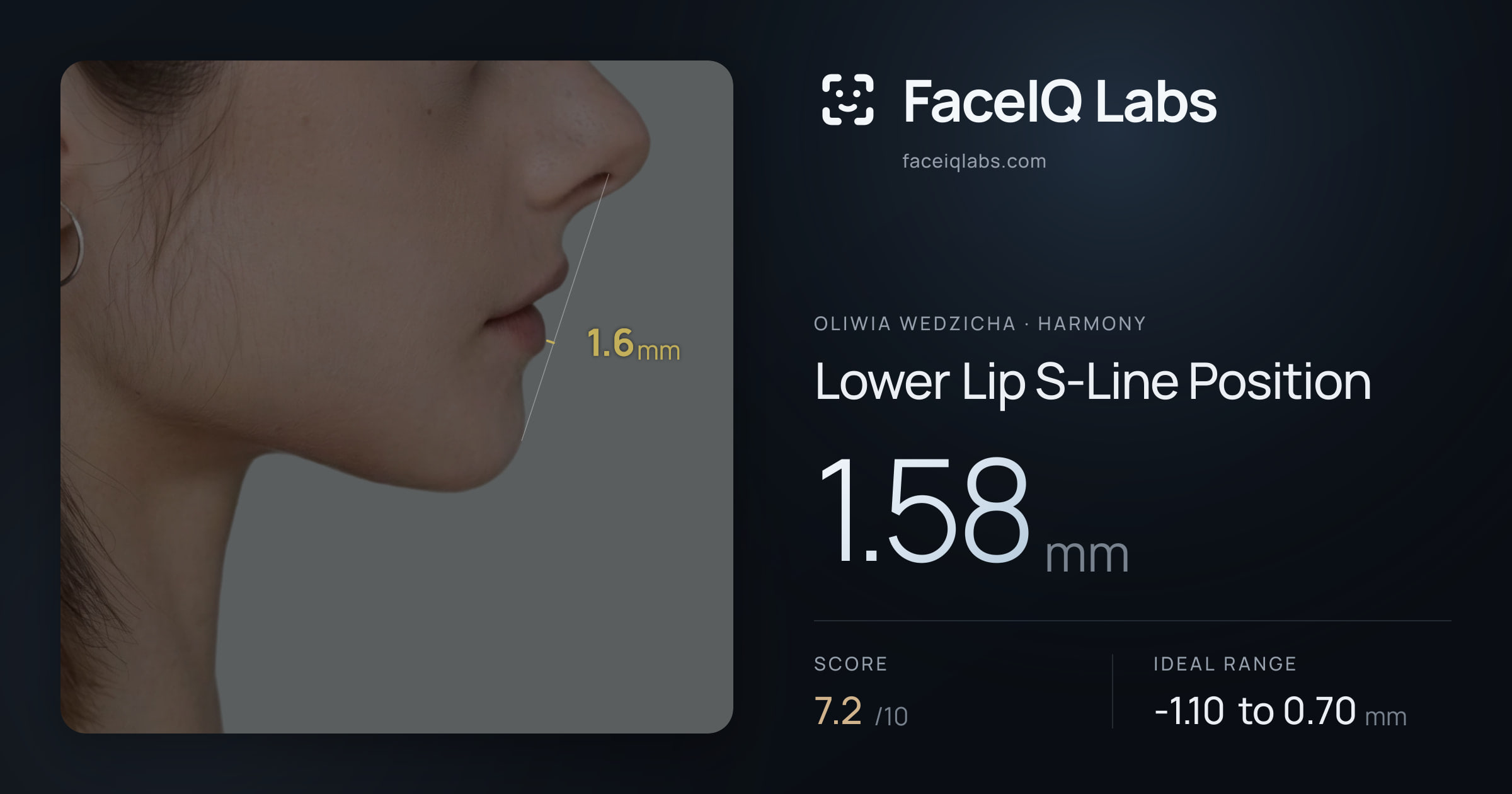 Oliwia Wedzicha Lower Lip S-Line Position: 1.58mm, drawn on the photo