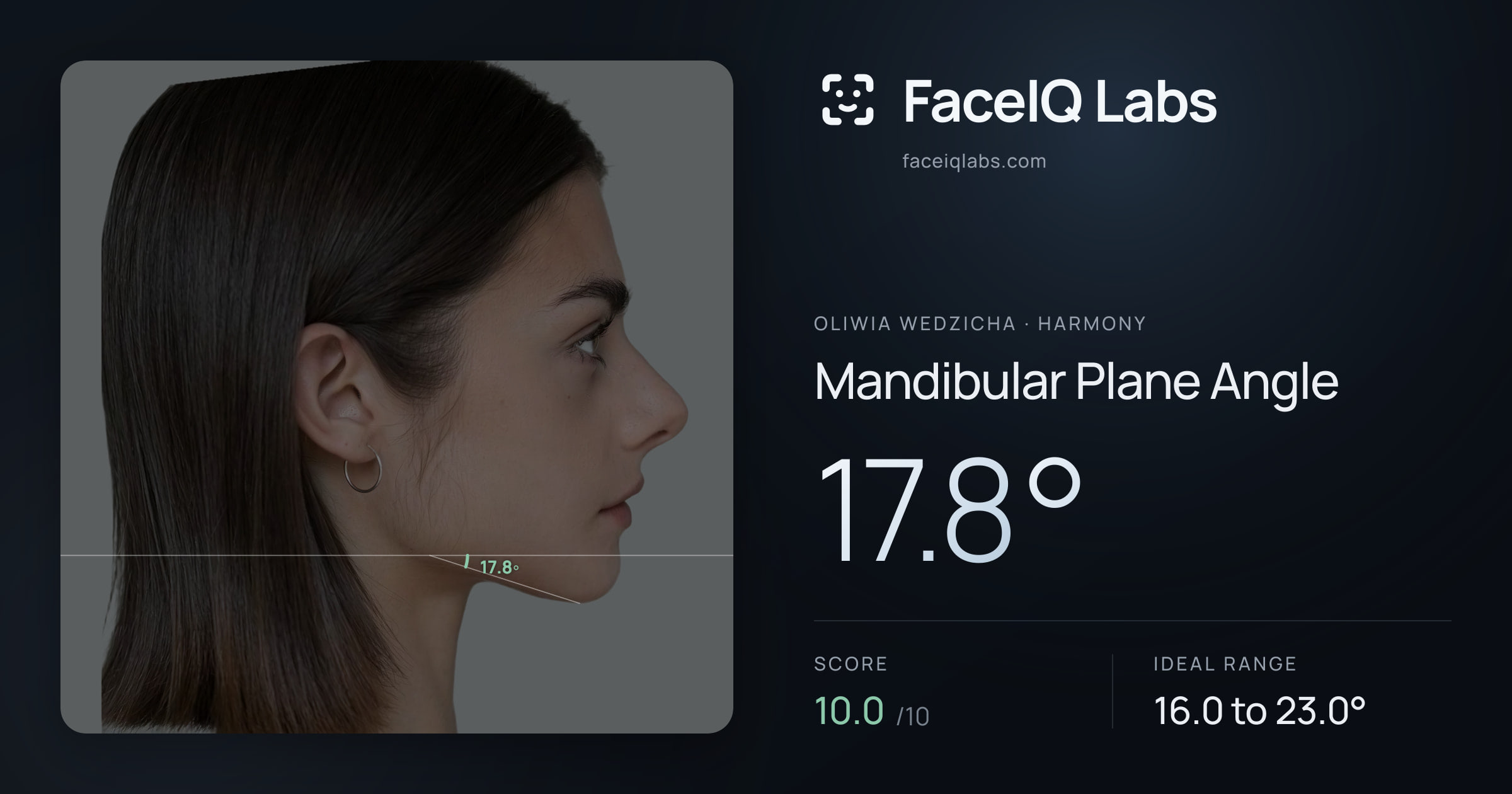 Oliwia Wedzicha Mandibular Plane Angle: 17.8°, drawn on the photo