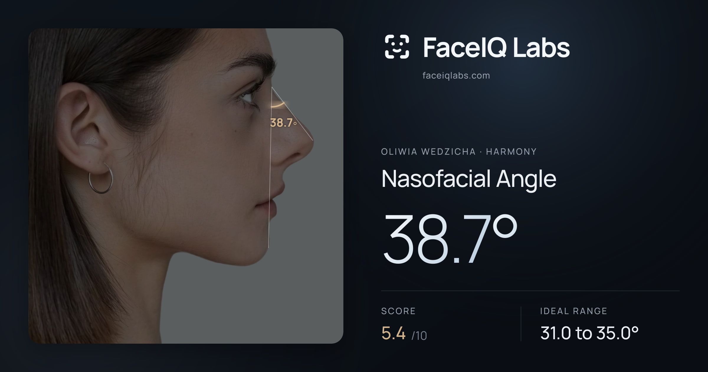 Oliwia Wedzicha Nasofacial Angle: 38.7°, drawn on the photo