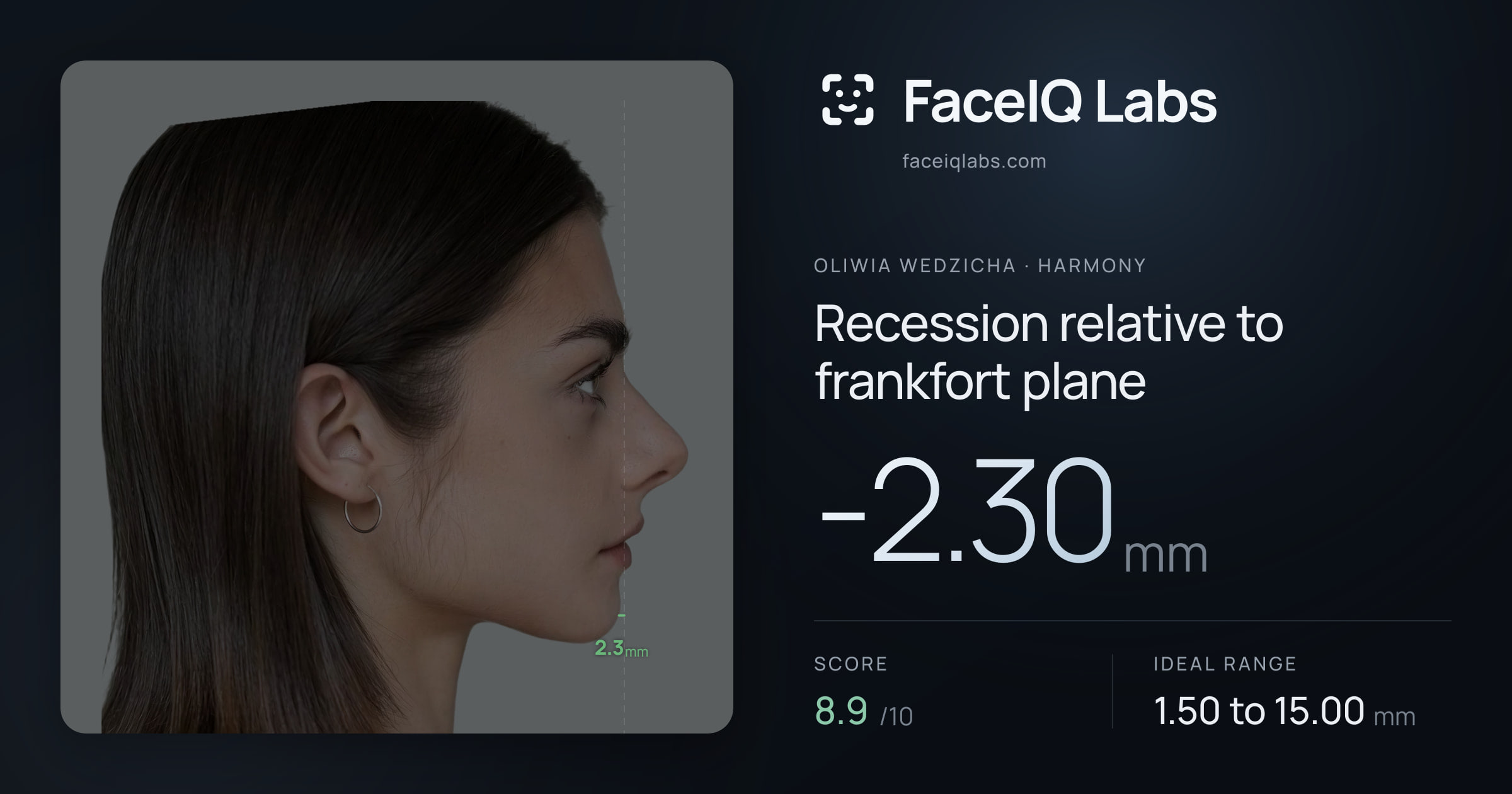 Oliwia Wedzicha Recession relative to frankfort plane: -2.30mm, drawn on the photo