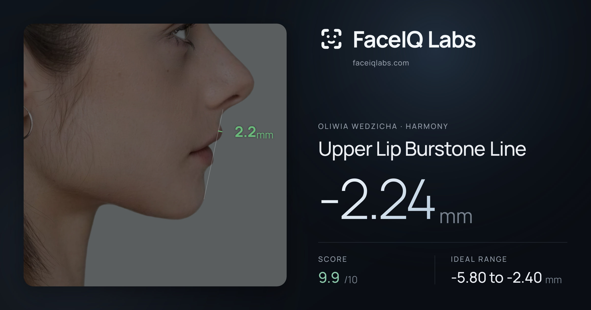 Oliwia Wedzicha Upper Lip Burstone Line: -2.24mm, drawn on the photo