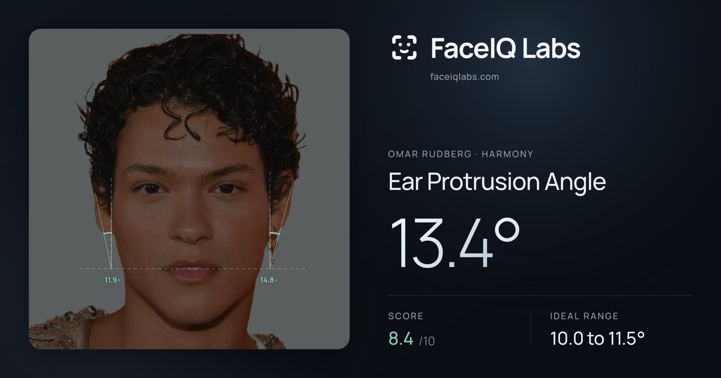 Omar Rudberg Ear Protrusion Angle: 13.4°, drawn on the photo