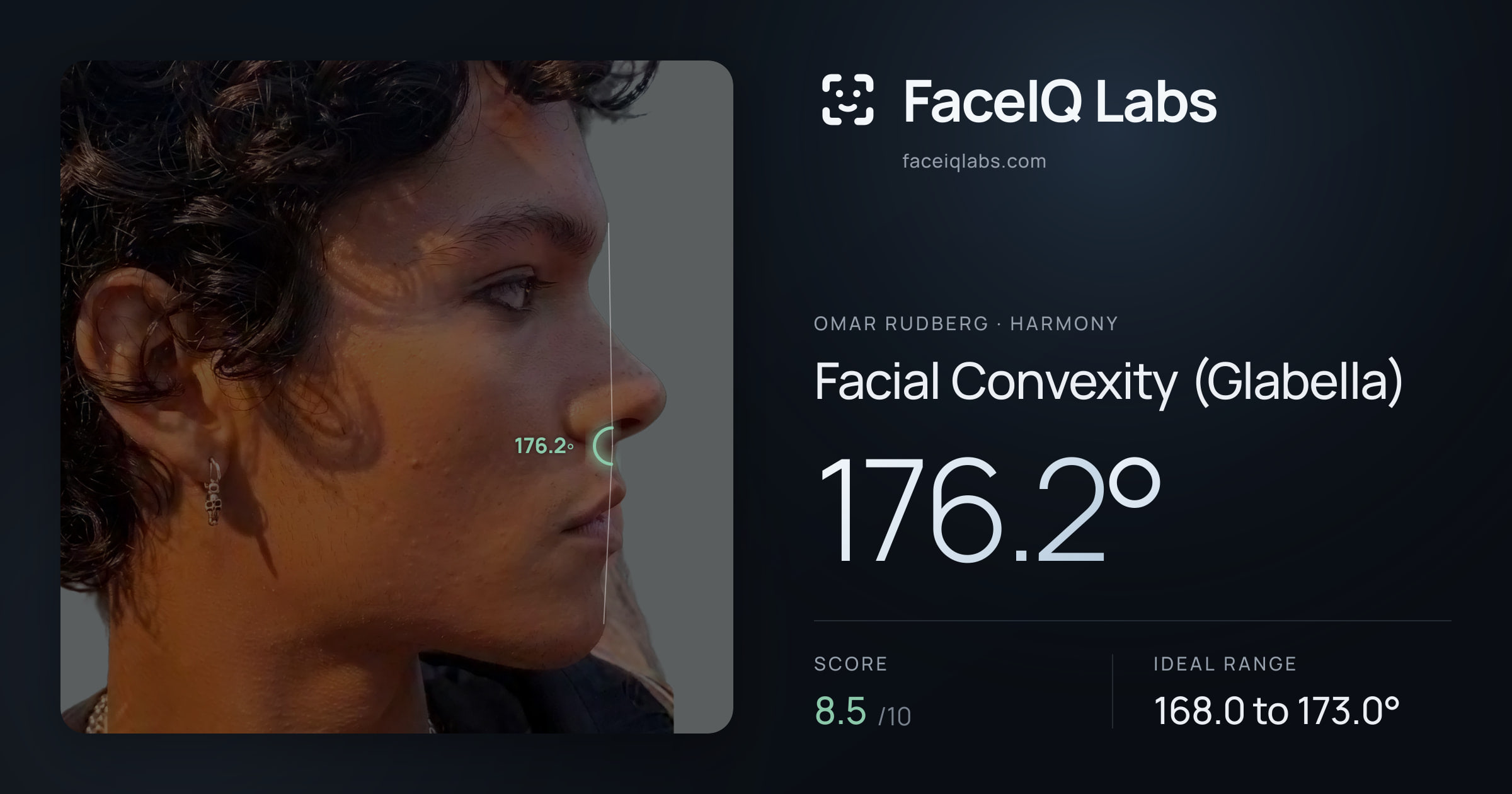 Omar Rudberg Facial Convexity (Glabella): 176.2°, drawn on the photo