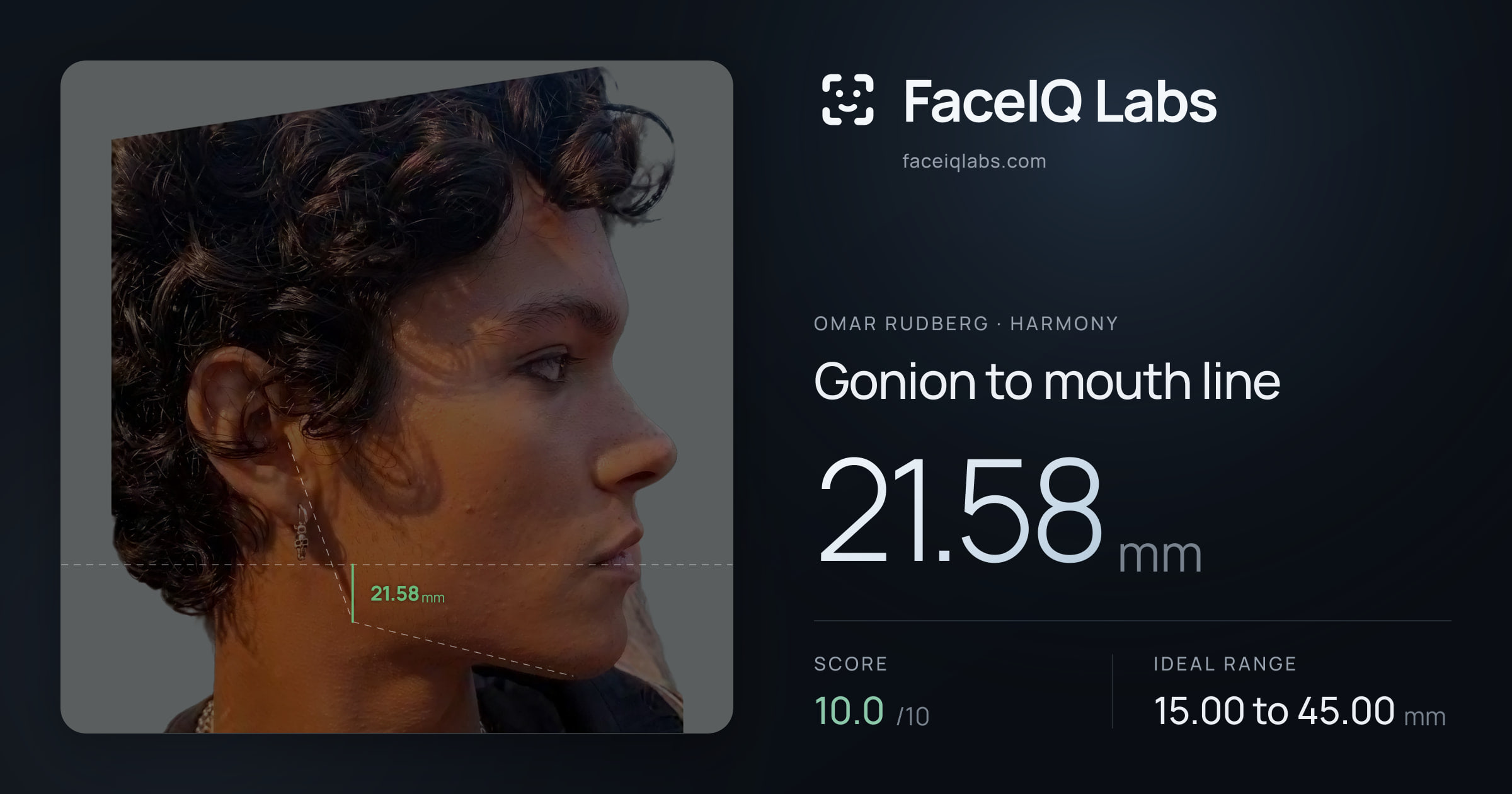 Omar Rudberg Gonion to mouth line: 21.58mm, drawn on the photo