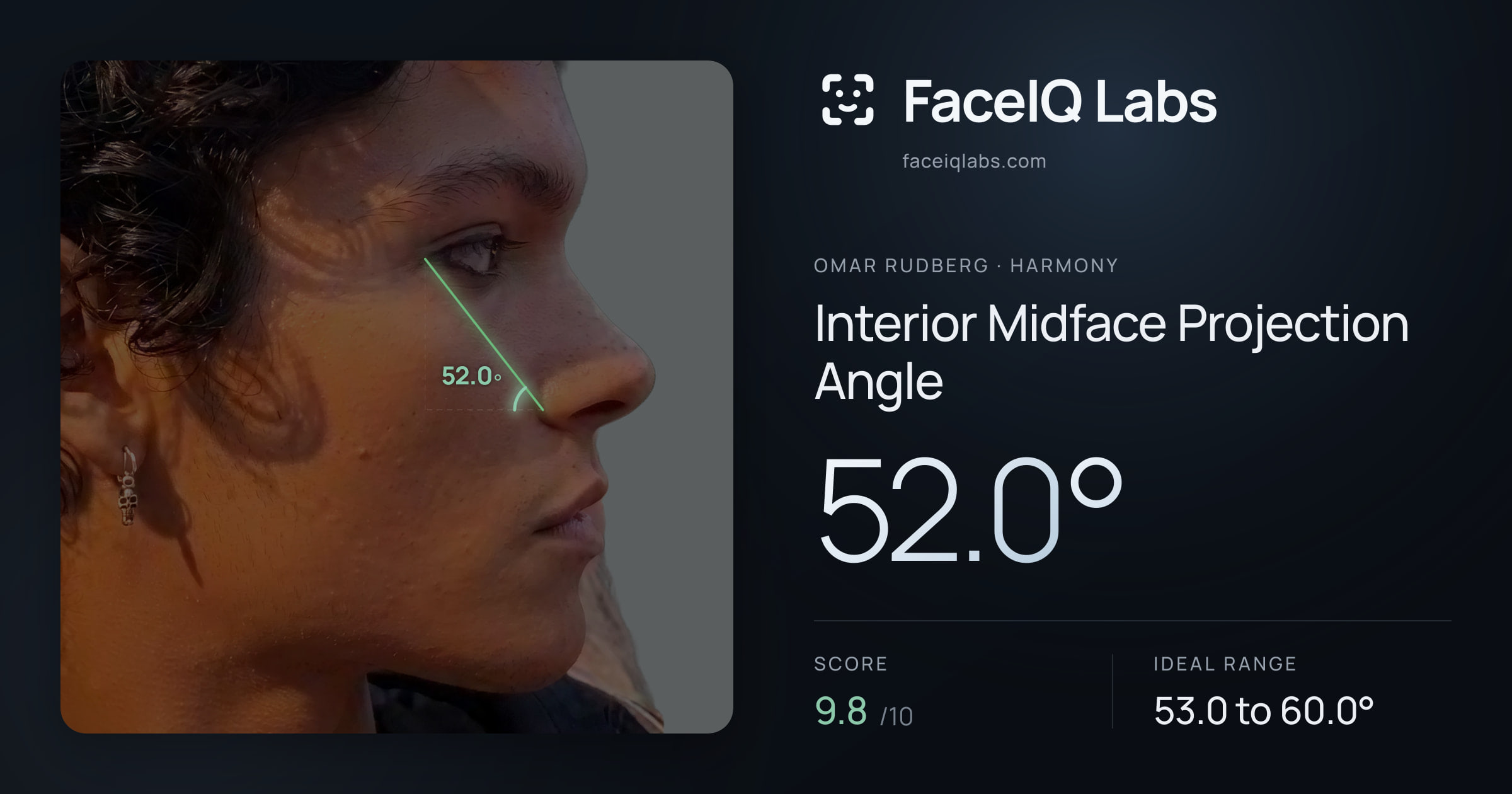 Omar Rudberg Interior Midface Projection Angle: 52.0°, drawn on the photo