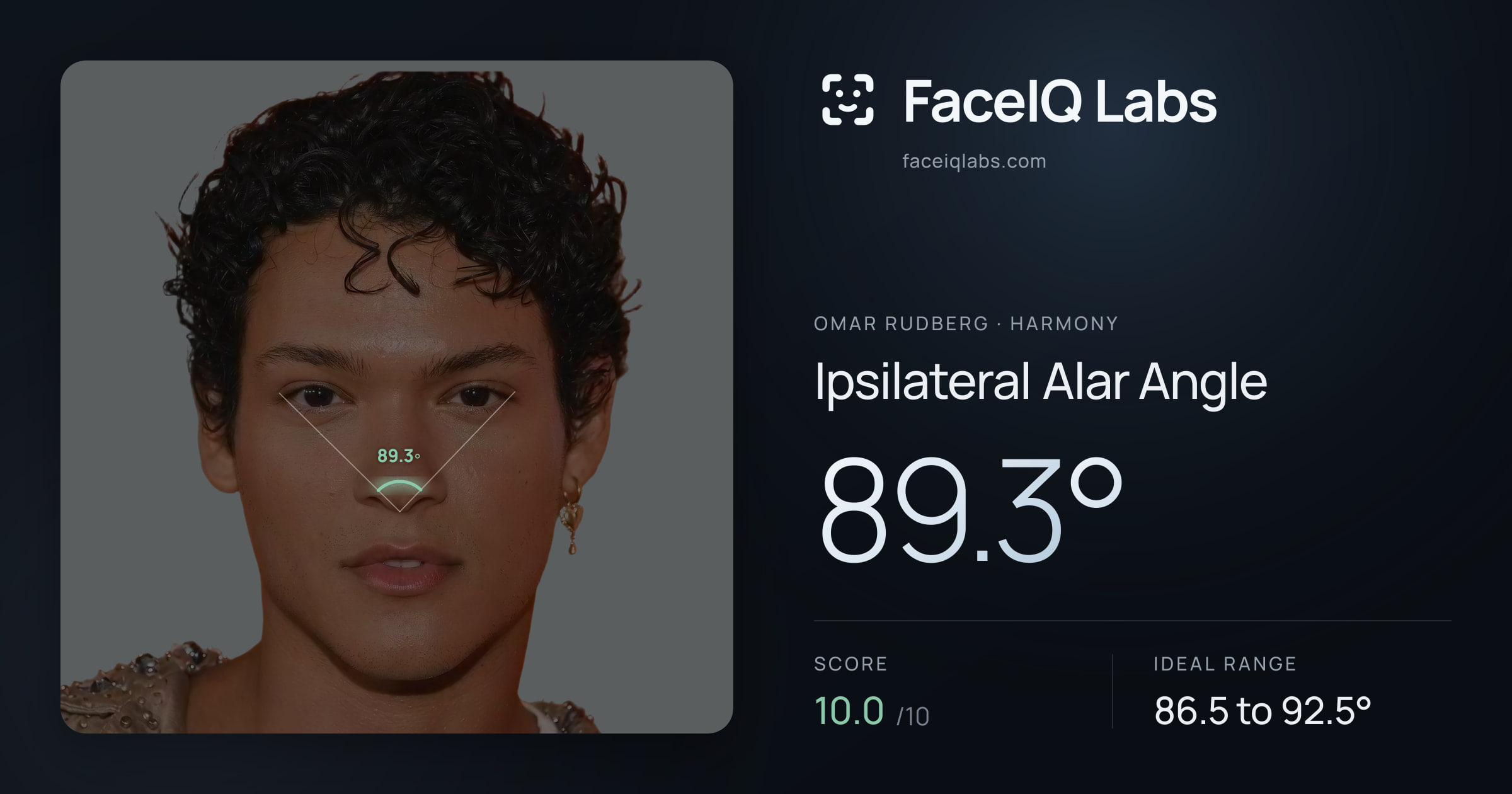 Omar Rudberg Ipsilateral Alar Angle: 89.3°, drawn on the photo