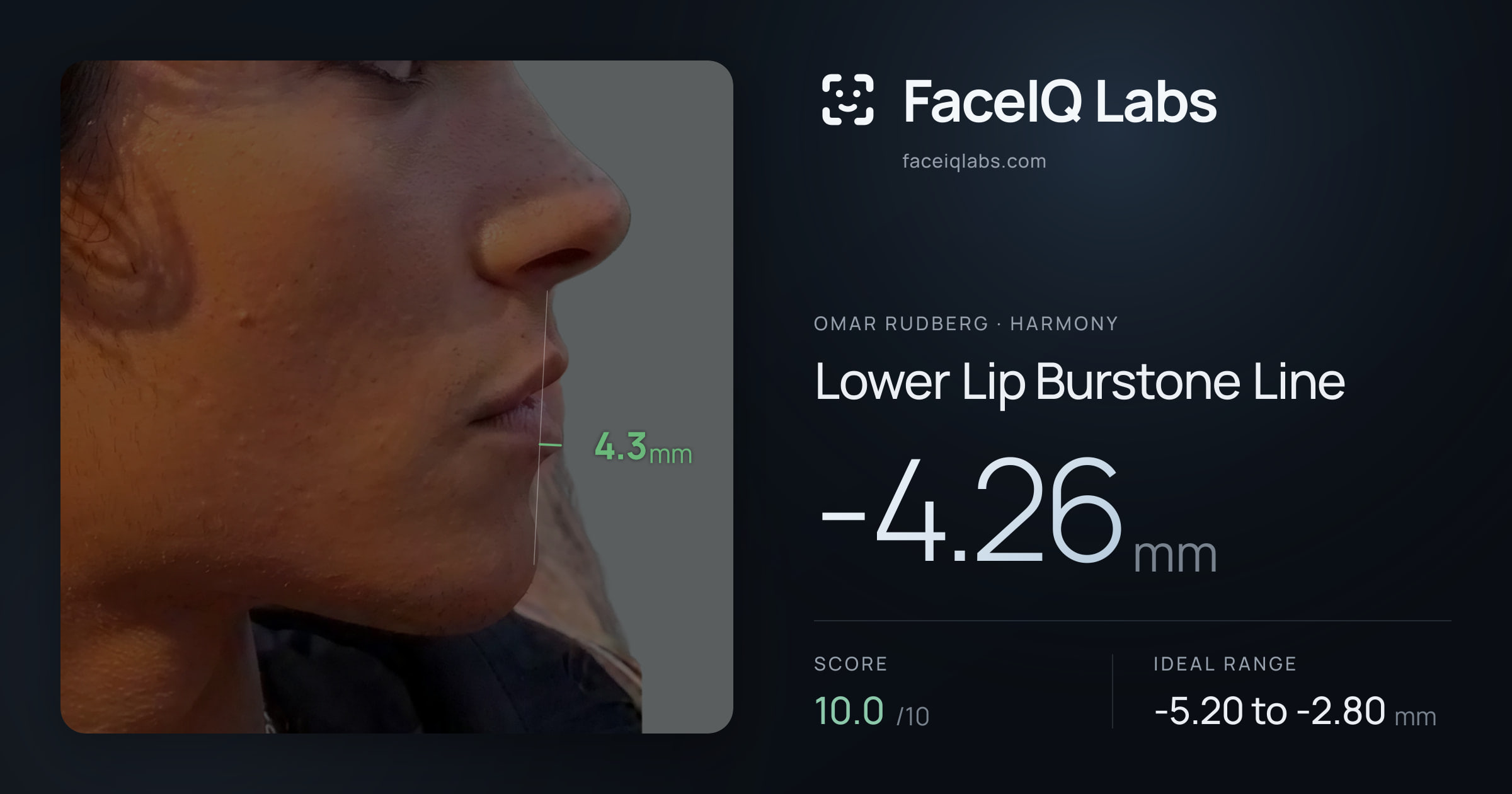 Omar Rudberg Lower Lip Burstone Line: -4.26mm, drawn on the photo