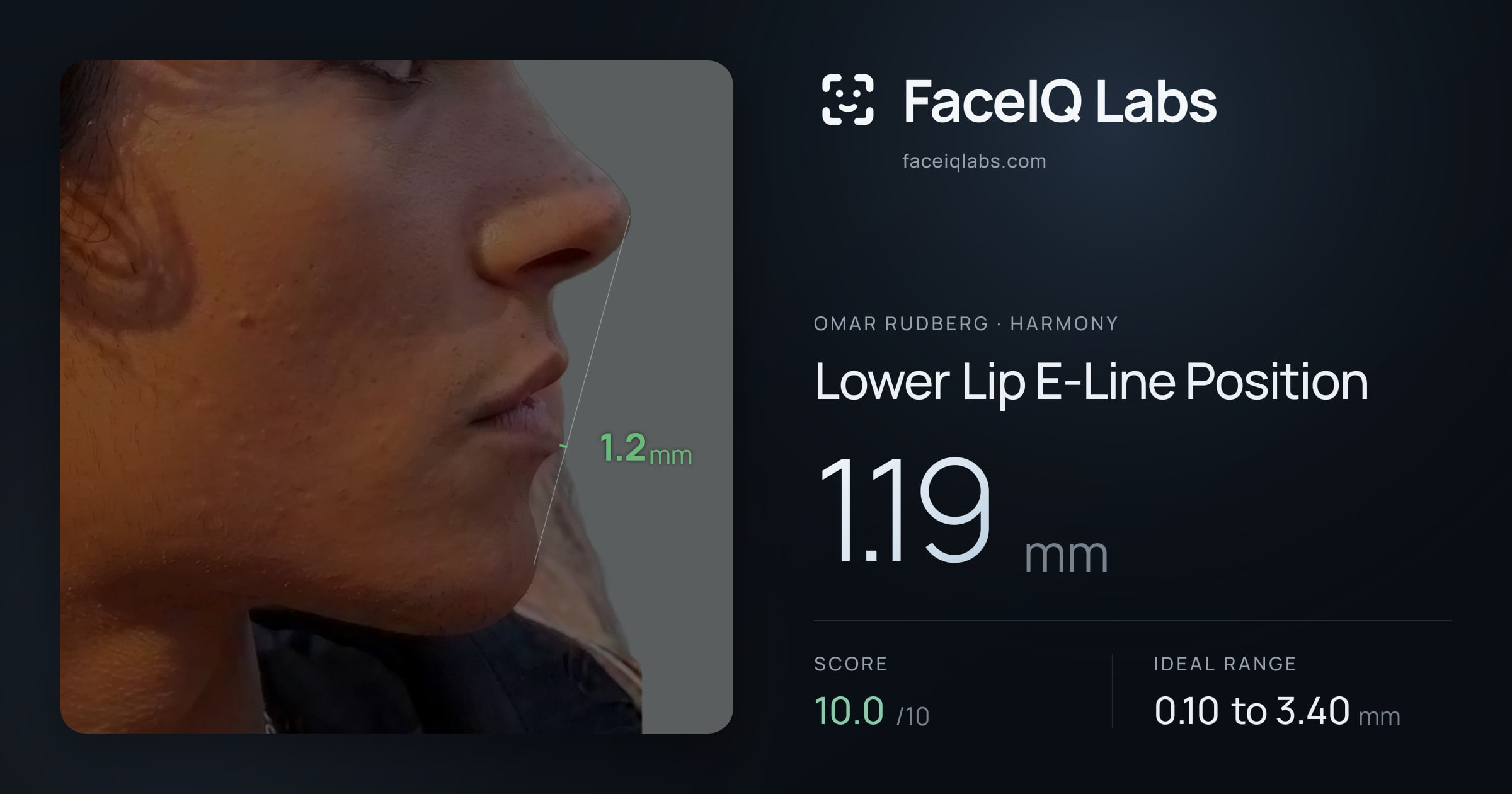 Omar Rudberg Lower Lip E-Line Position: 1.19mm, drawn on the photo