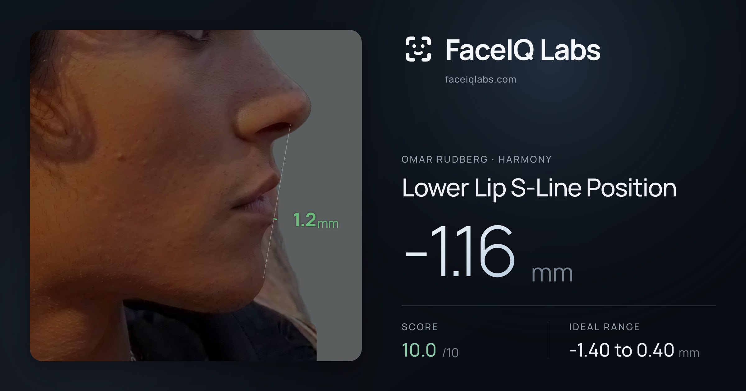 Omar Rudberg Lower Lip S-Line Position: -1.16mm, drawn on the photo