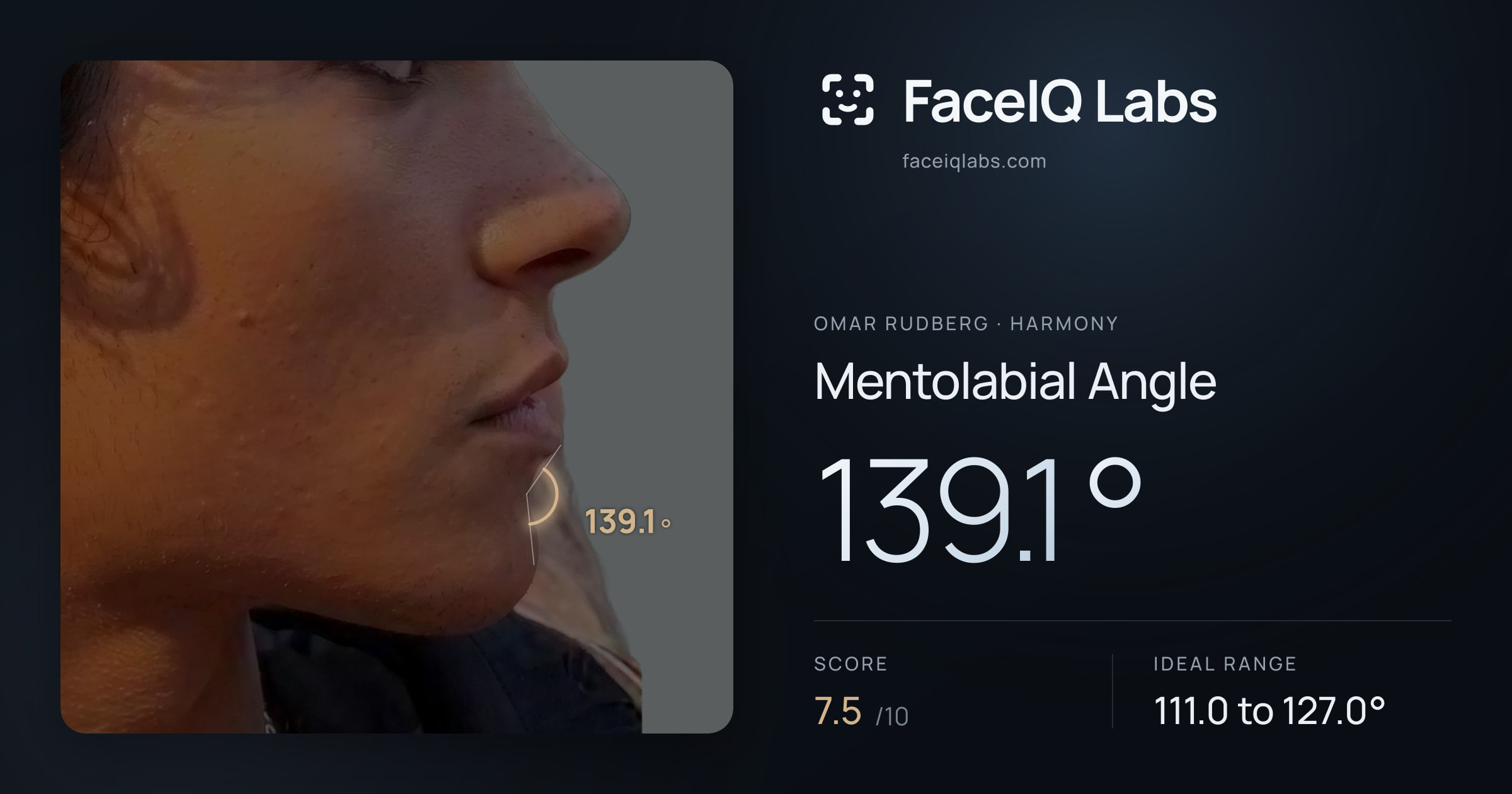 Omar Rudberg Mentolabial Angle: 139.1°, drawn on the photo