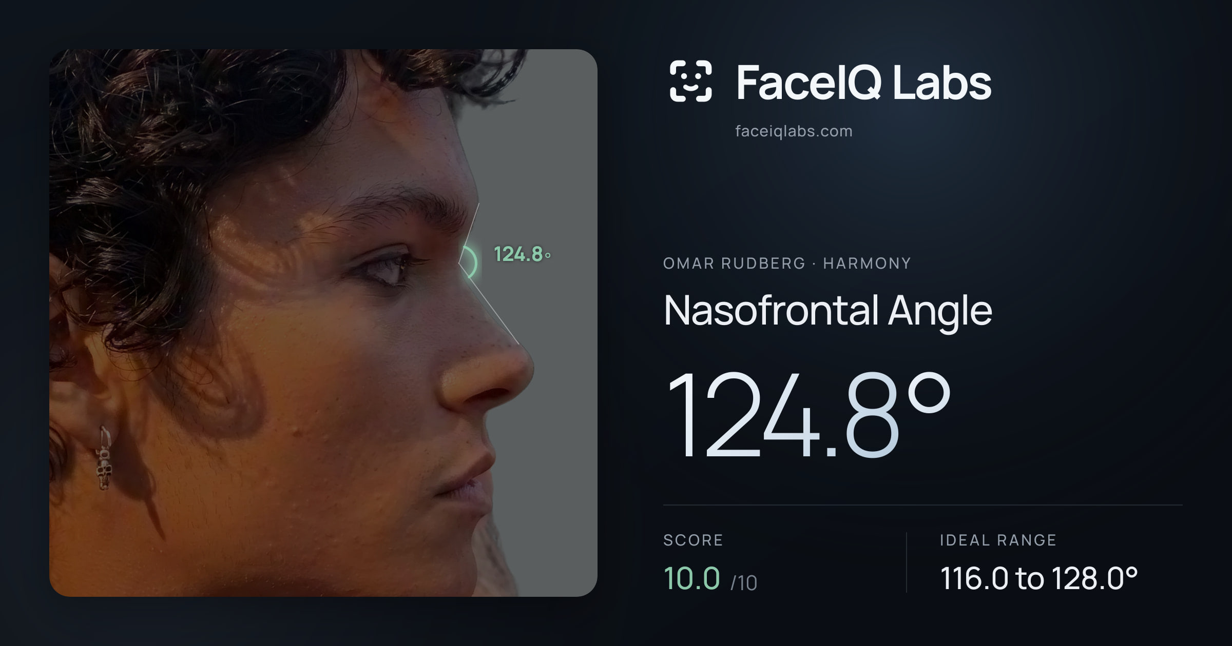 Omar Rudberg Nasofrontal Angle: 124.8°, drawn on the photo