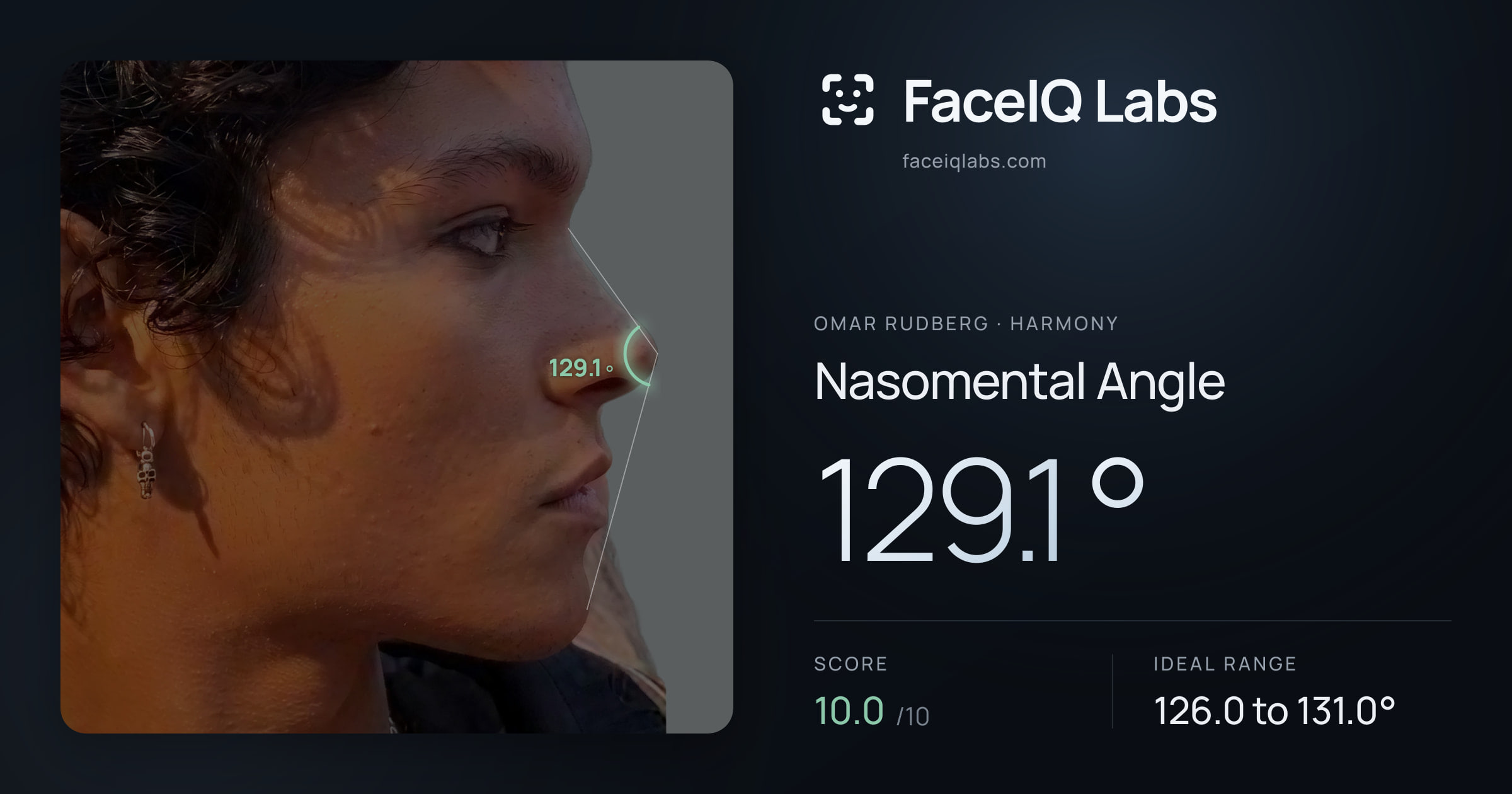 Omar Rudberg Nasomental Angle: 129.1°, drawn on the photo