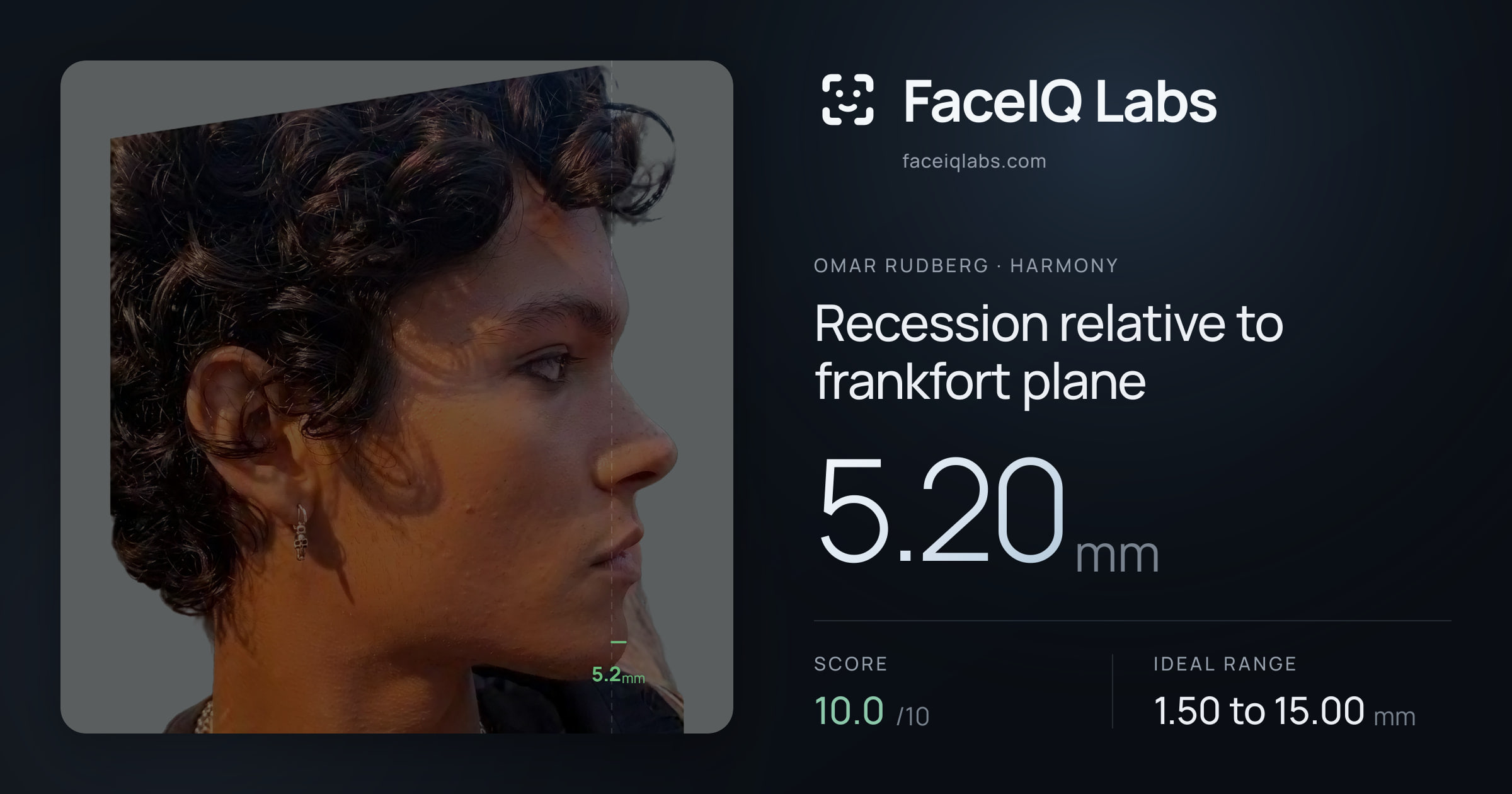 Omar Rudberg Recession relative to frankfort plane: 5.20mm, drawn on the photo