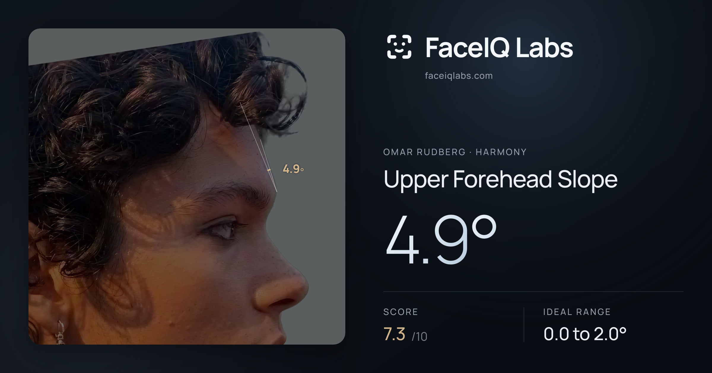 Omar Rudberg Upper Forehead Slope: 4.9°, drawn on the photo