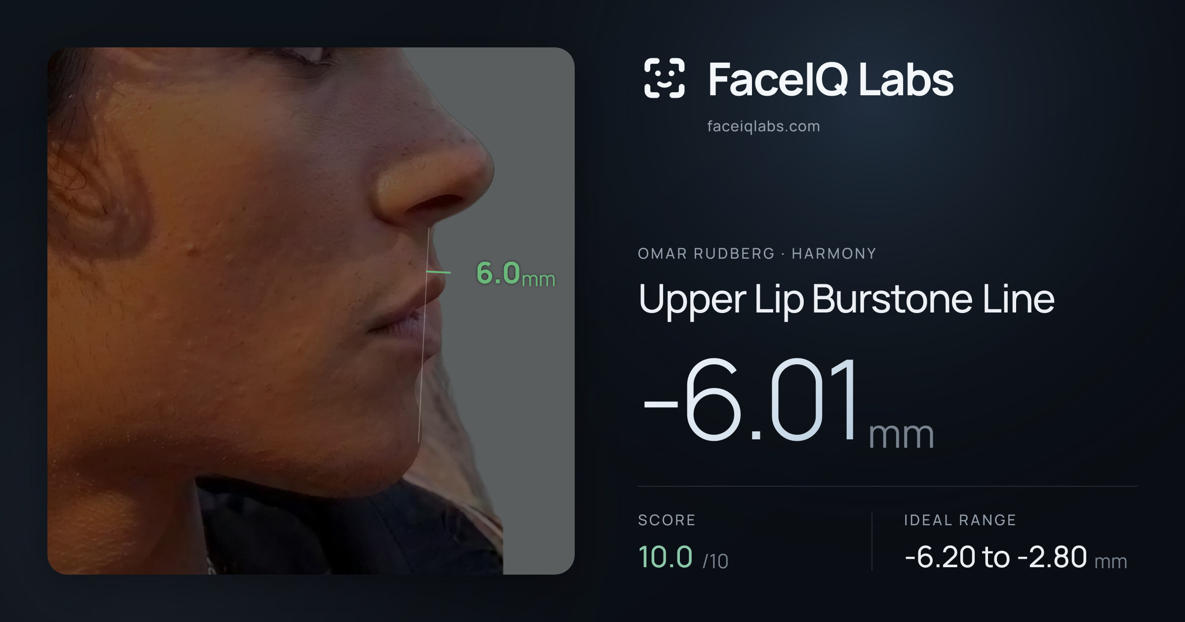 Omar Rudberg Upper Lip Burstone Line: -6.01mm, drawn on the photo