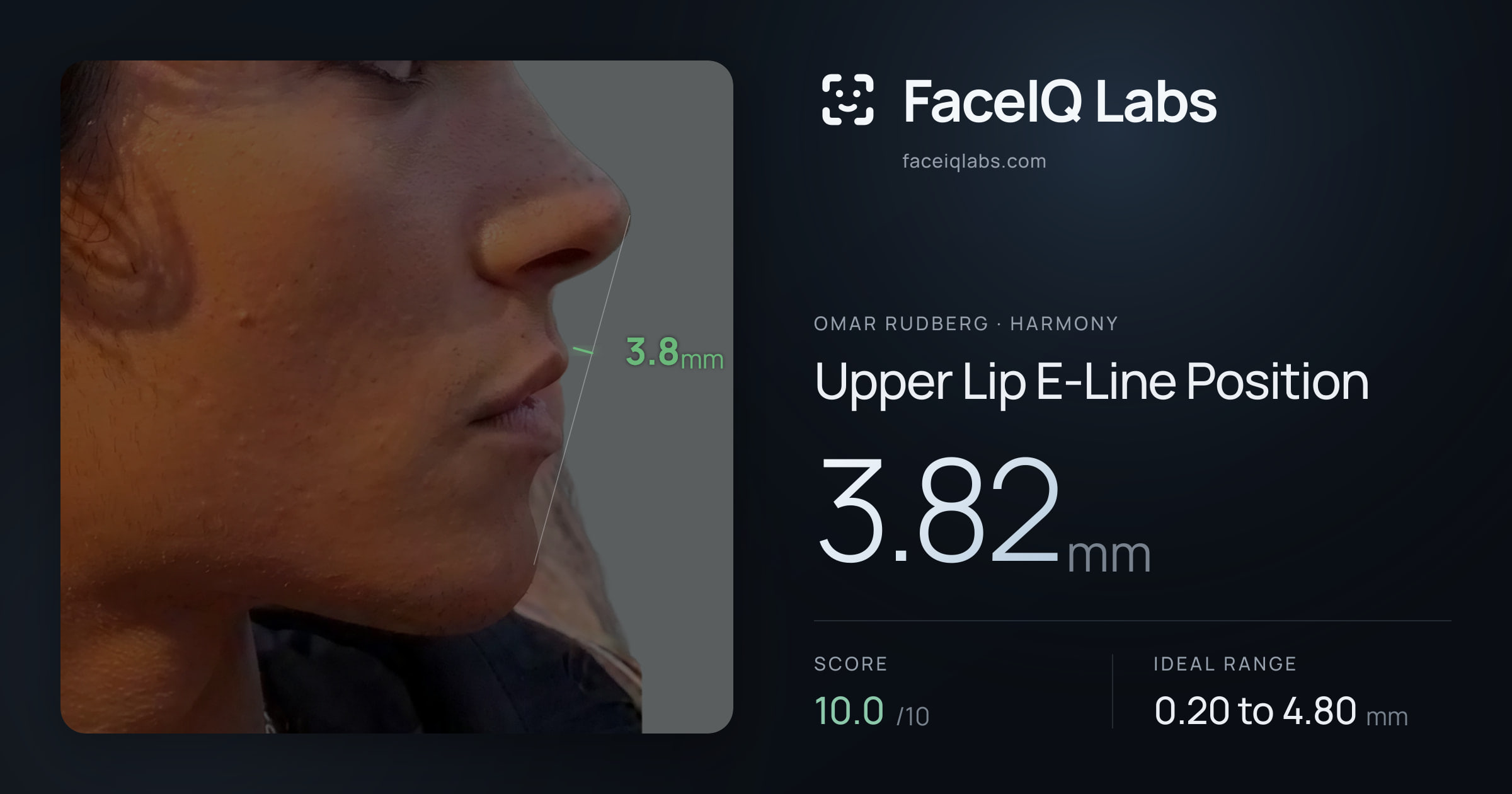 Omar Rudberg Upper Lip E-Line Position: 3.82mm, drawn on the photo
