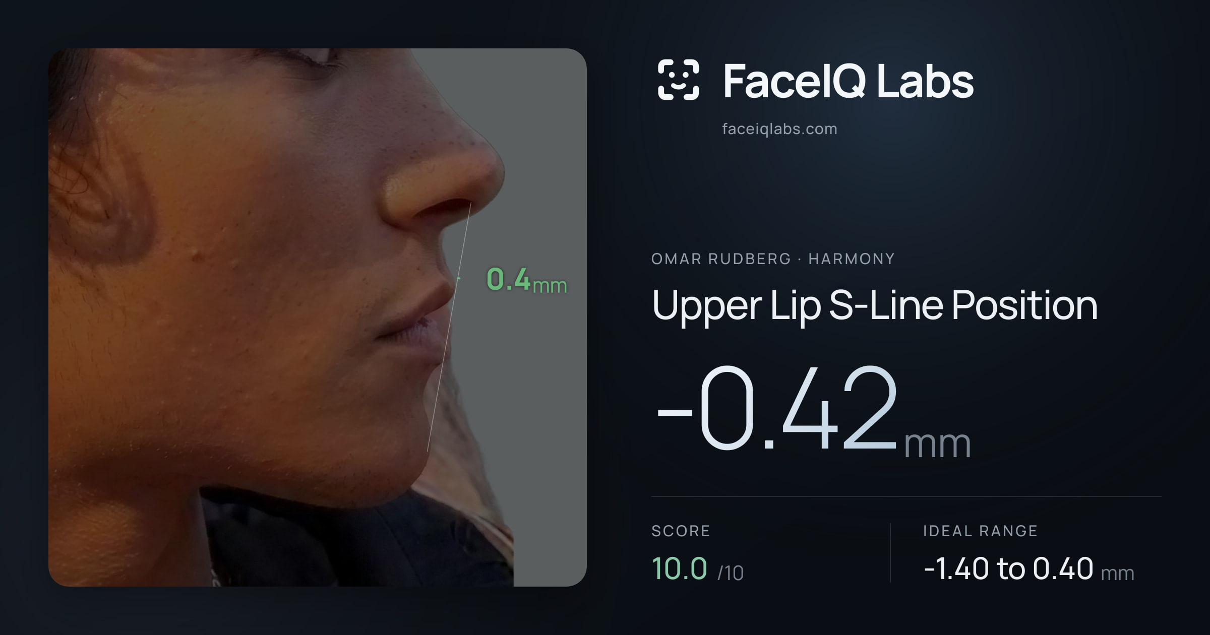 Omar Rudberg Upper Lip S-Line Position: -0.42mm, drawn on the photo