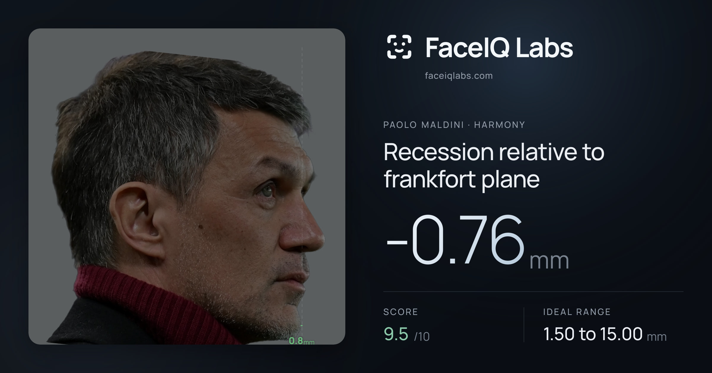 Paolo Maldini Recession relative to frankfort plane: -0.76mm, drawn on the photo