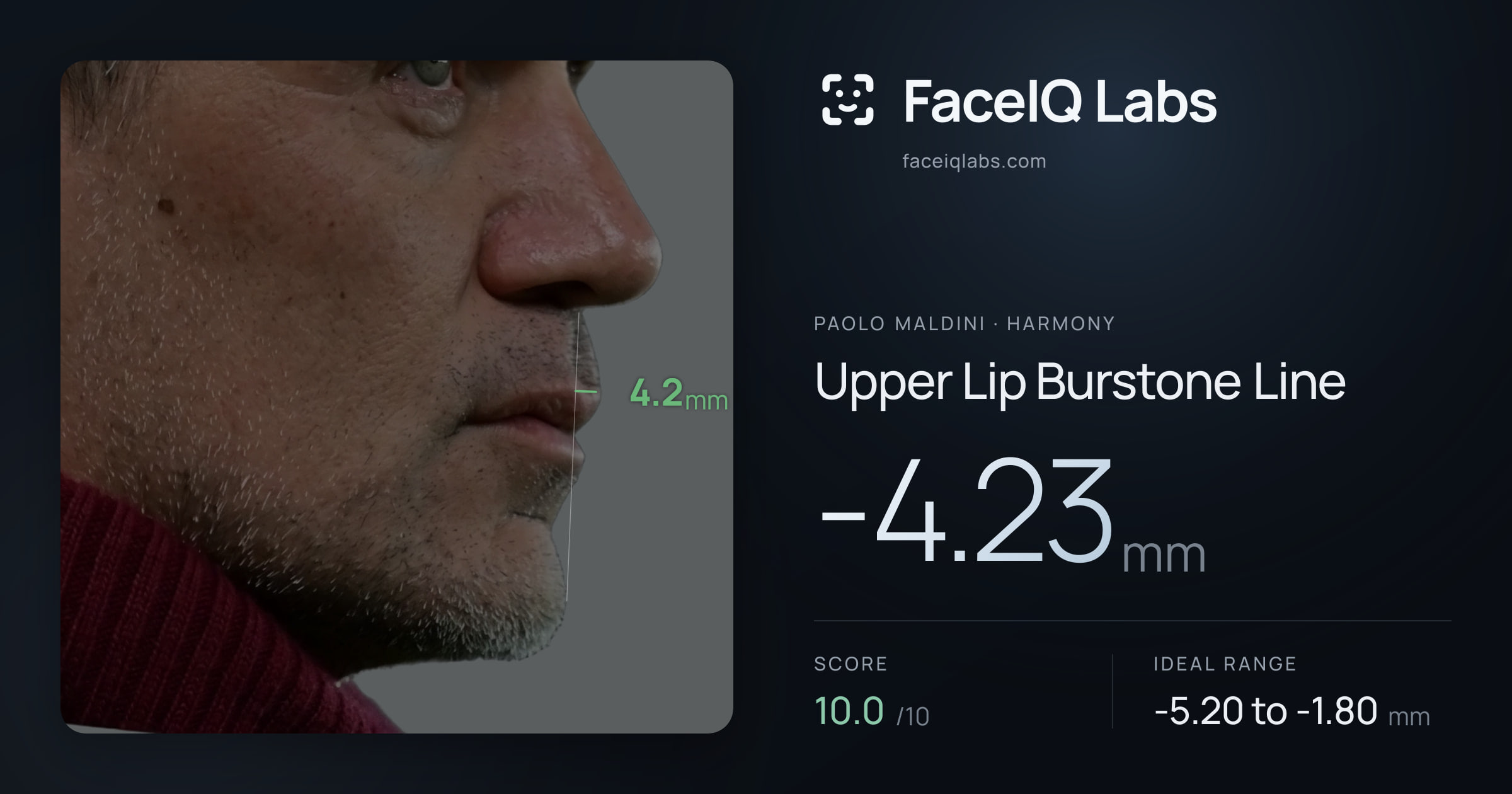 Paolo Maldini Upper Lip Burstone Line: -4.23mm, drawn on the photo