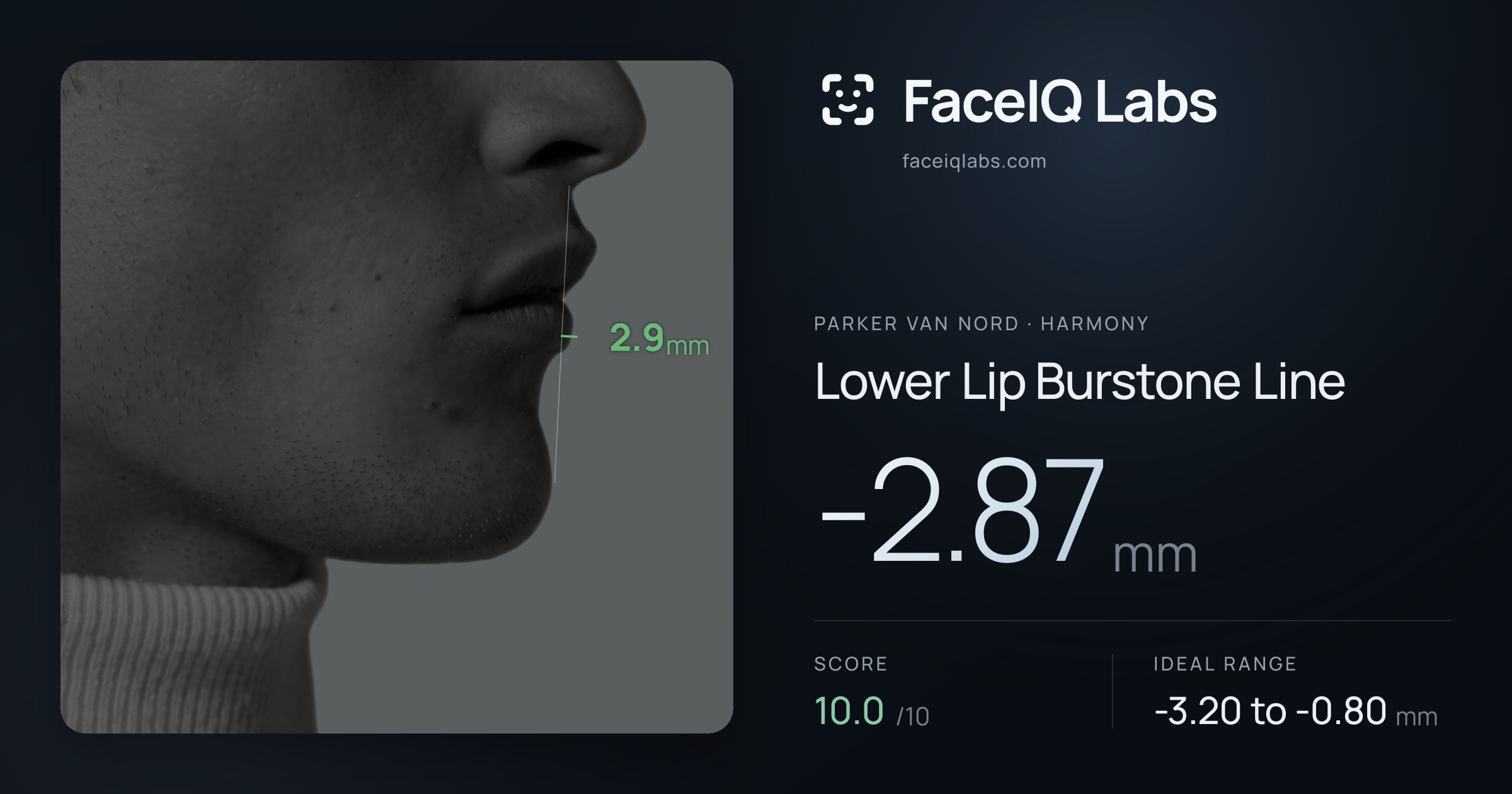 Parker Van Nord Lower Lip Burstone Line: -2.87mm, drawn on the photo