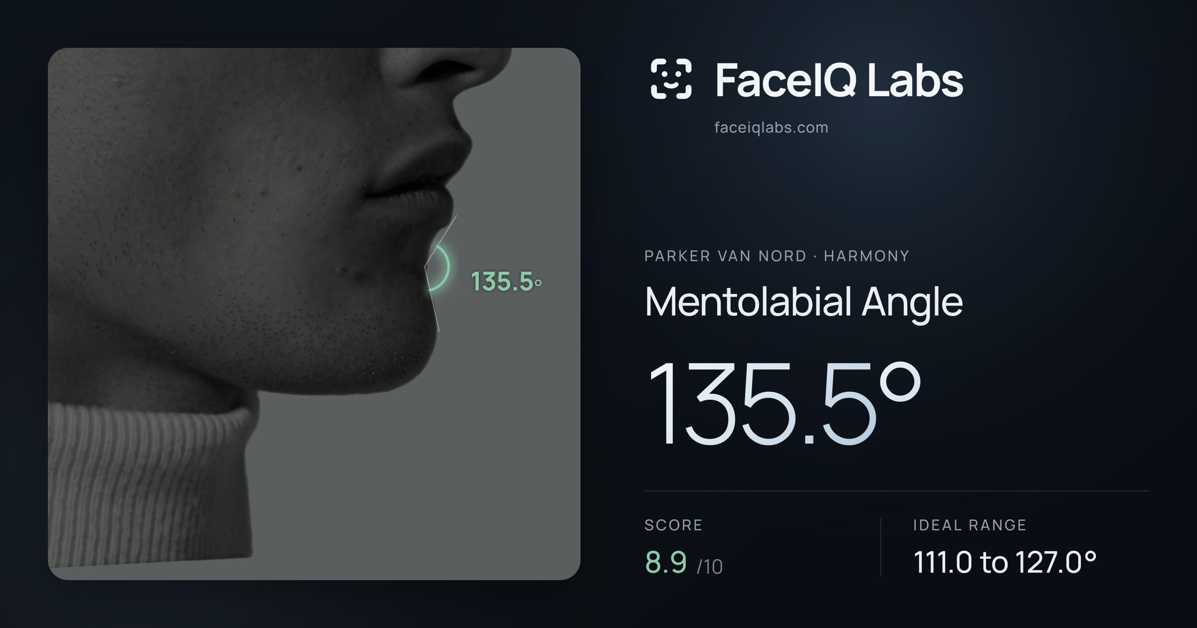 Parker Van Nord Mentolabial Angle: 135.5°, drawn on the photo