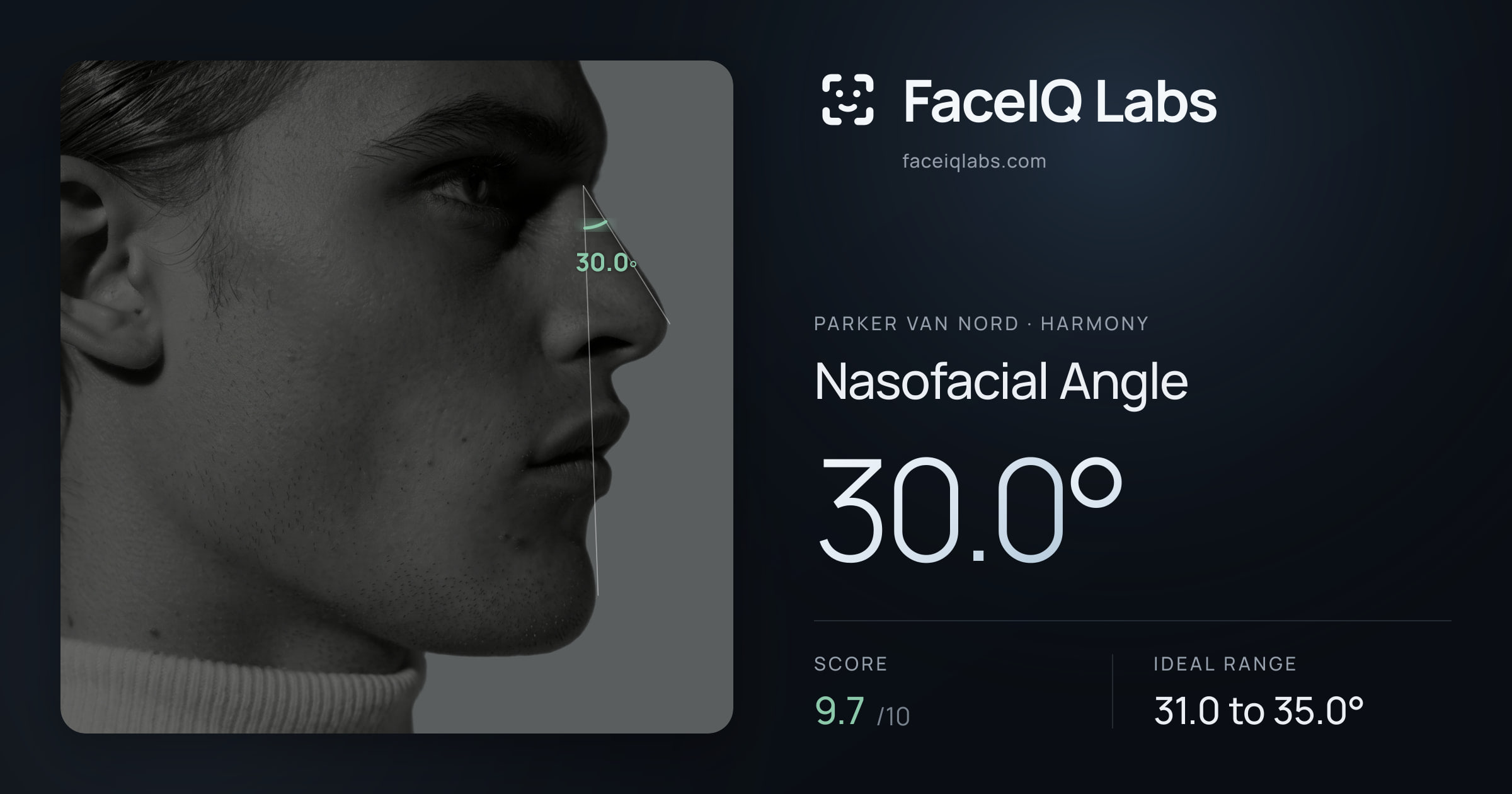 Parker Van Nord Nasofacial Angle: 30.0°, drawn on the photo