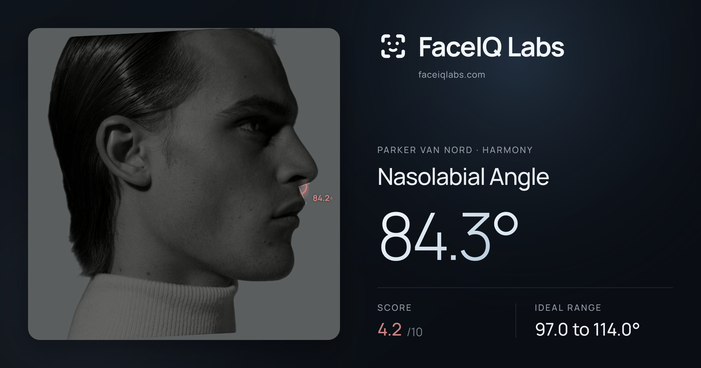 Parker Van Nord Nasolabial Angle: 84.3°, drawn on the photo