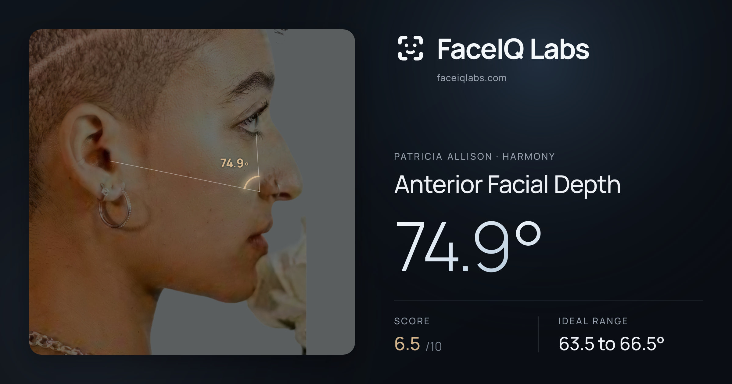Patricia Allison Anterior Facial Depth: 74.9°, drawn on the photo