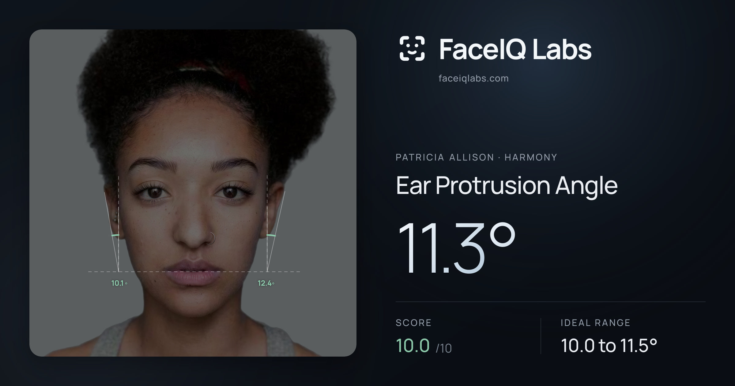 Patricia Allison Ear Protrusion Angle: 11.3°, drawn on the photo