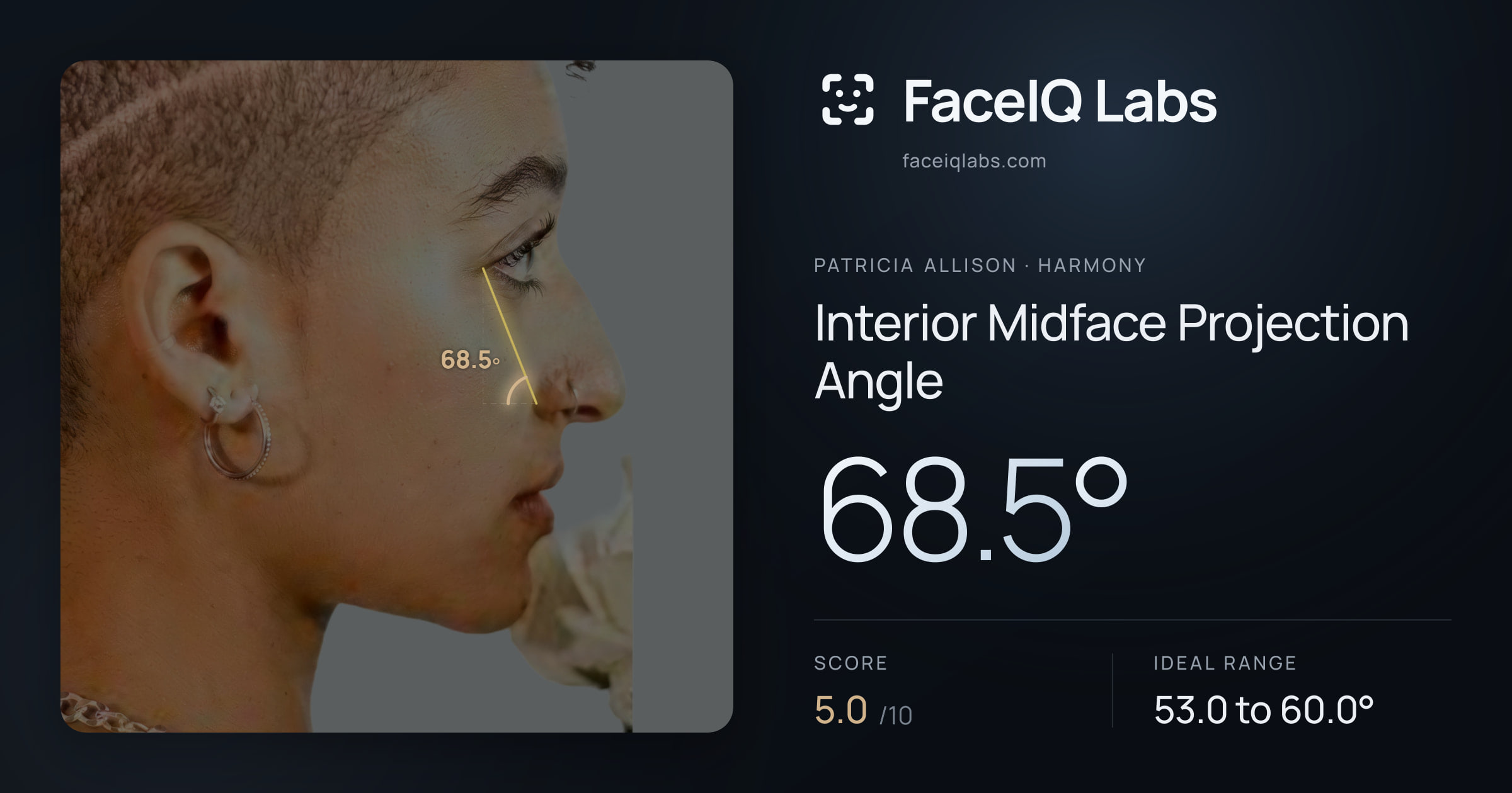 Patricia Allison Interior Midface Projection Angle: 68.5°, drawn on the photo