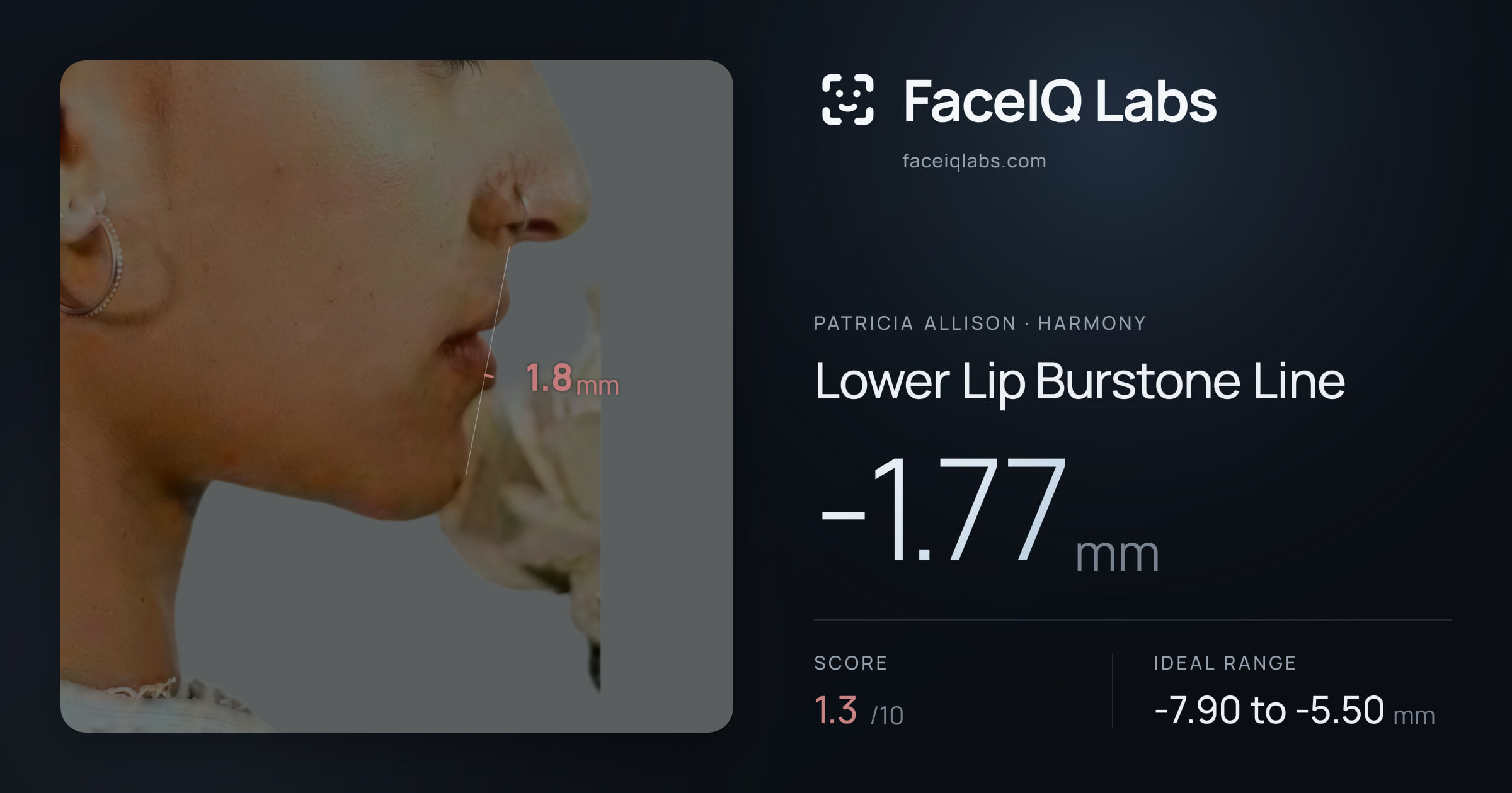 Patricia Allison Lower Lip Burstone Line: -1.77mm, drawn on the photo