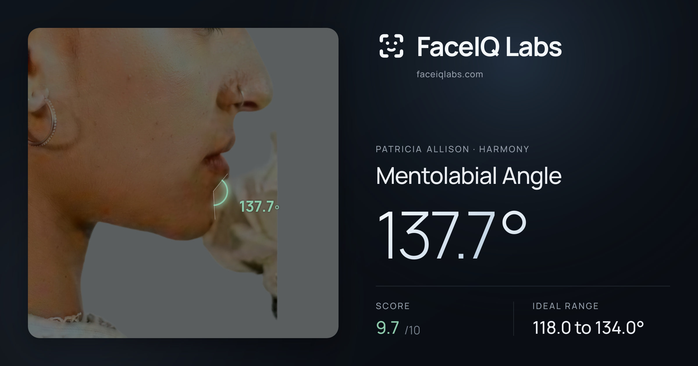 Patricia Allison Mentolabial Angle: 137.7°, drawn on the photo