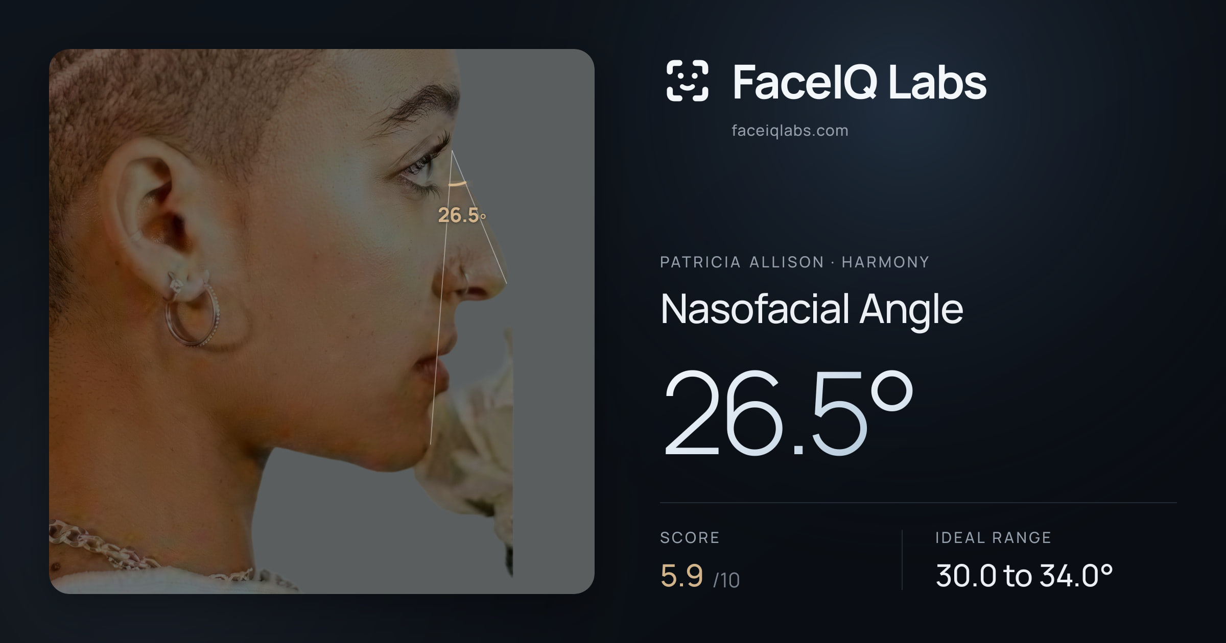 Patricia Allison Nasofacial Angle: 26.5°, drawn on the photo