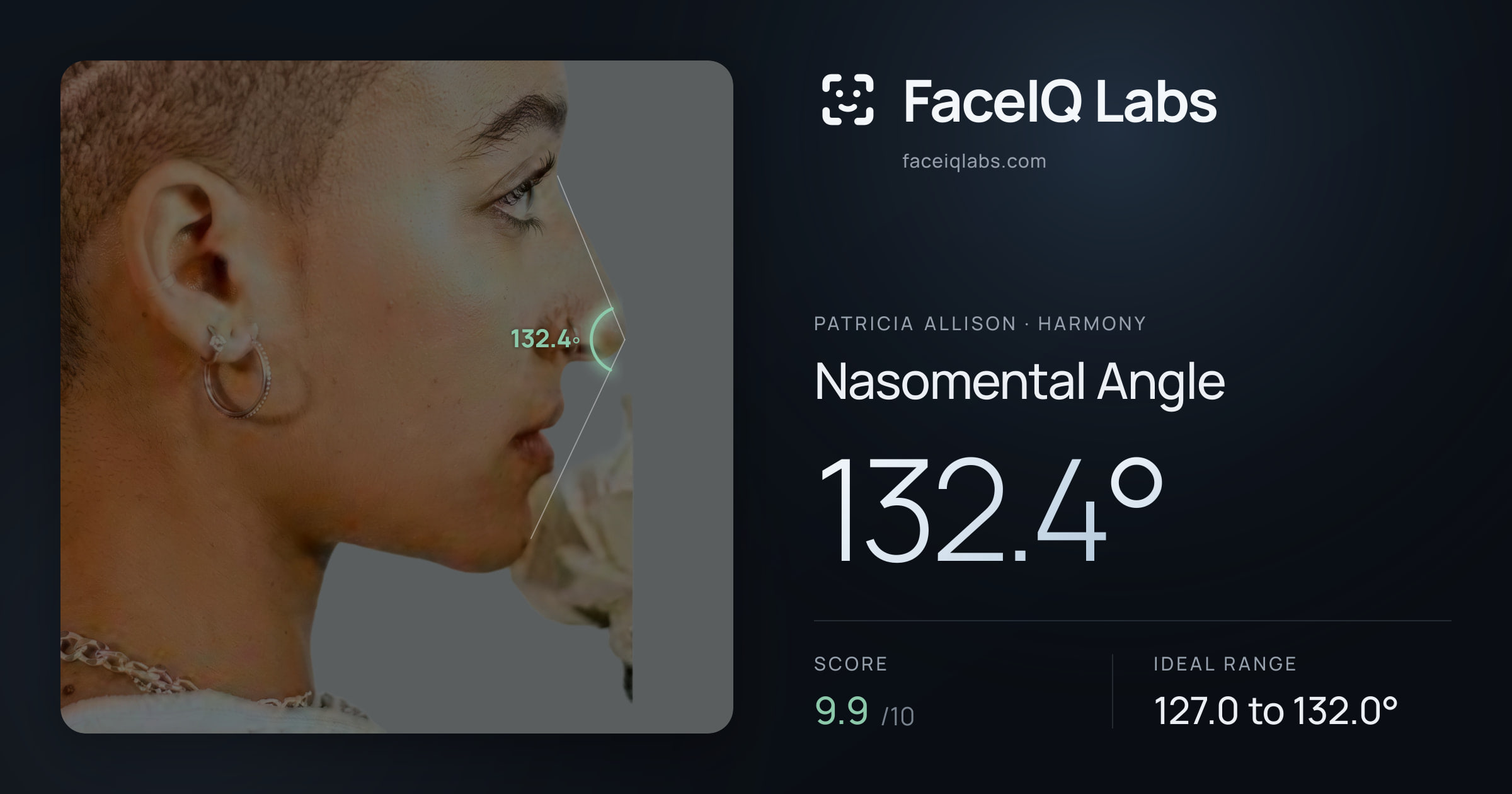 Patricia Allison Nasomental Angle: 132.4°, drawn on the photo